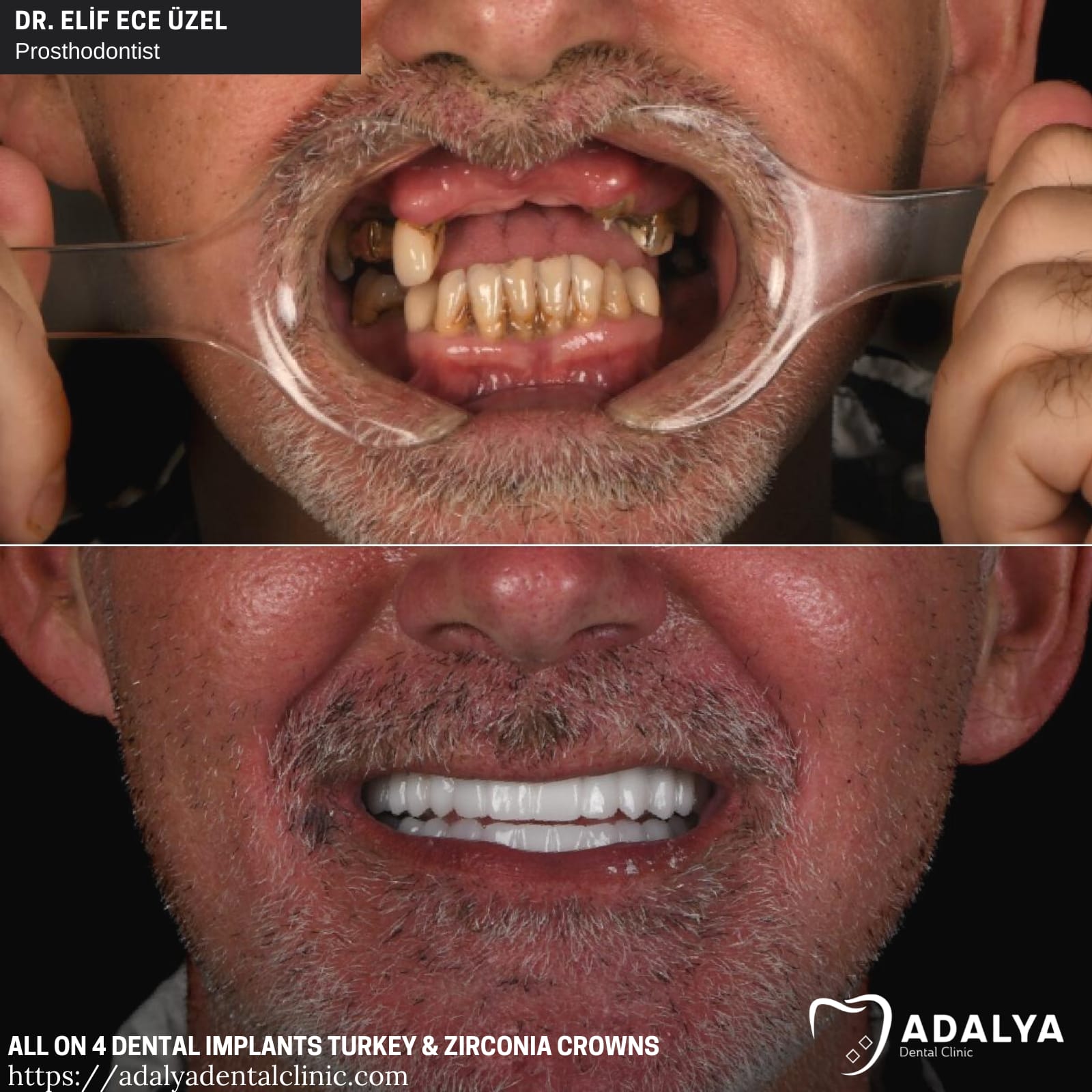 adalya all on four dental implants turkey price antalya