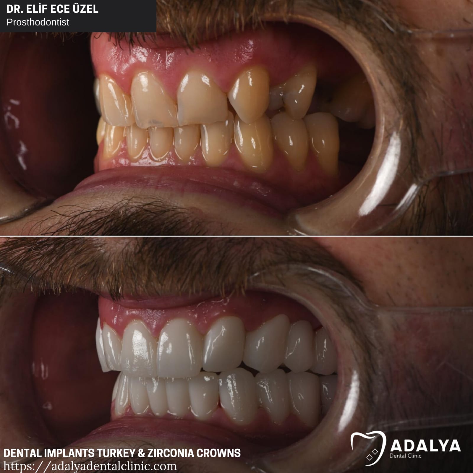 adalya dental implants turkey antalya zirconia crowns cost