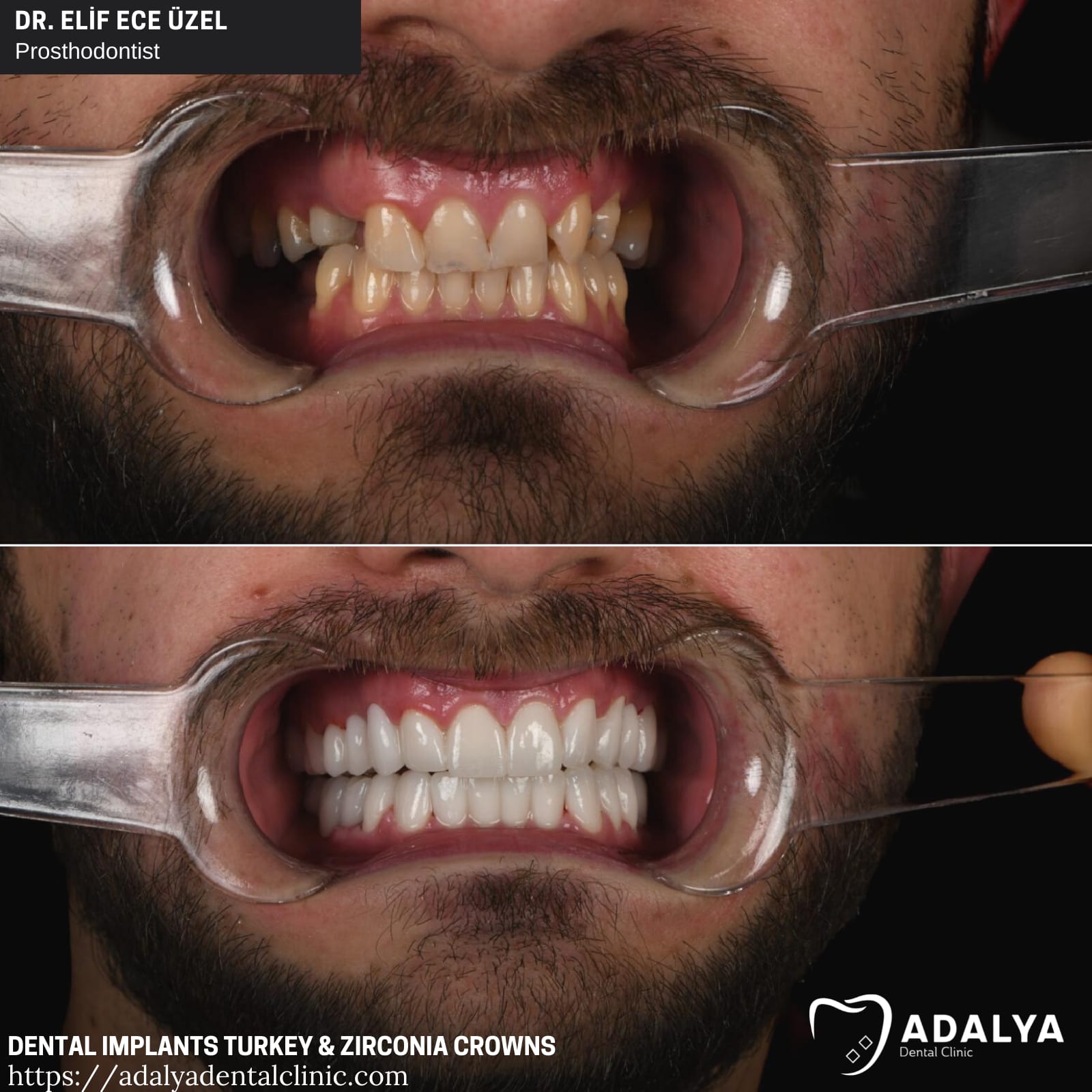 adalya dental implants turkey zirconia crowns cost