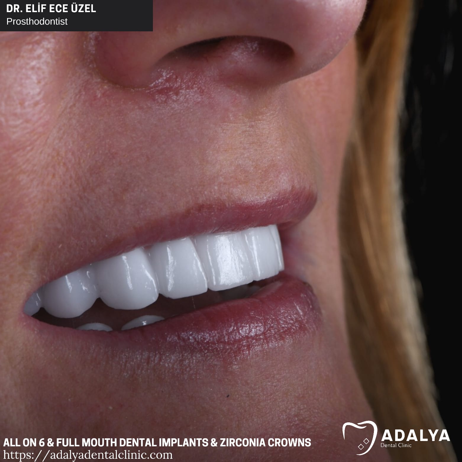 adalya full mouth dental implants package deals antalya price