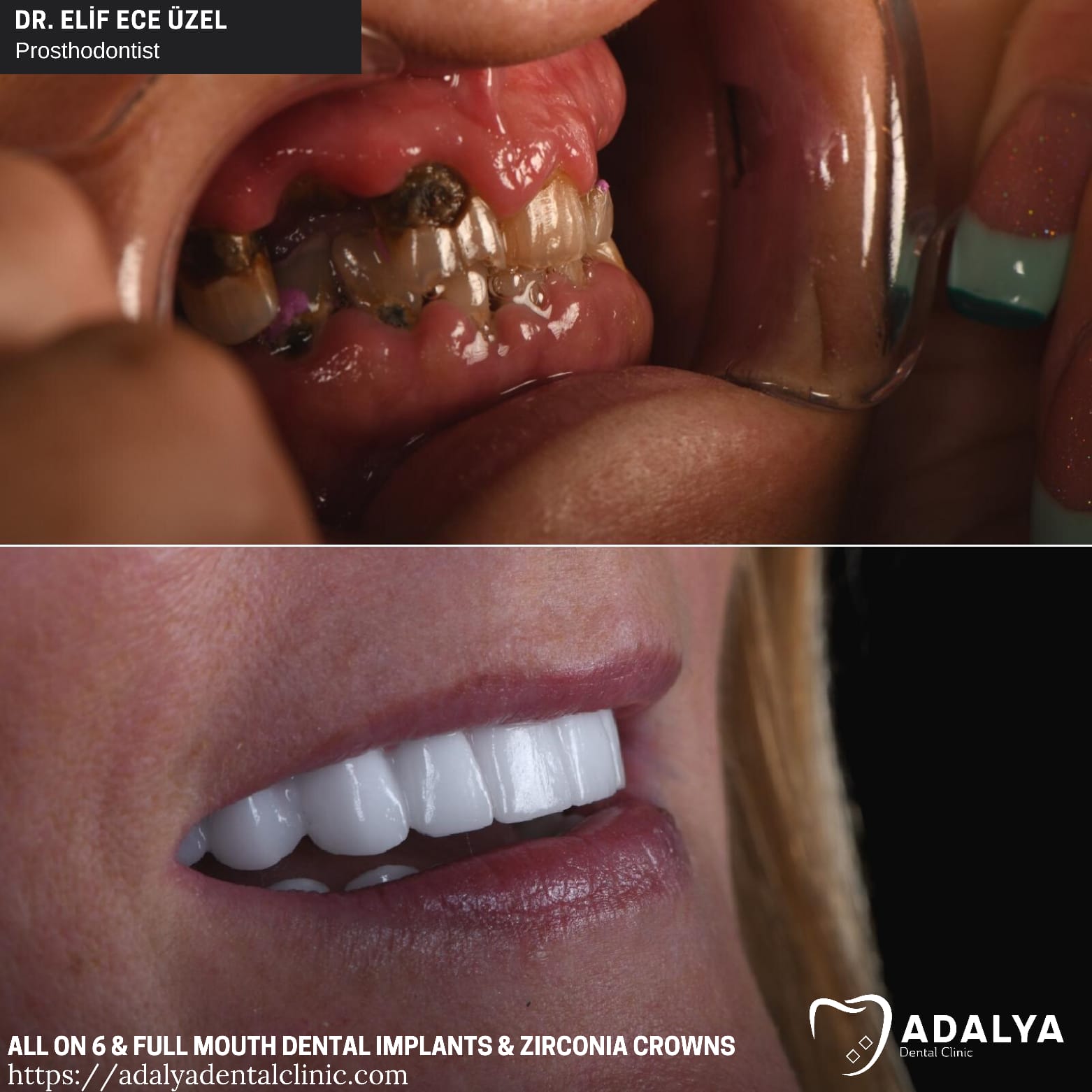 adalya full mouth dental implants package deals antalya