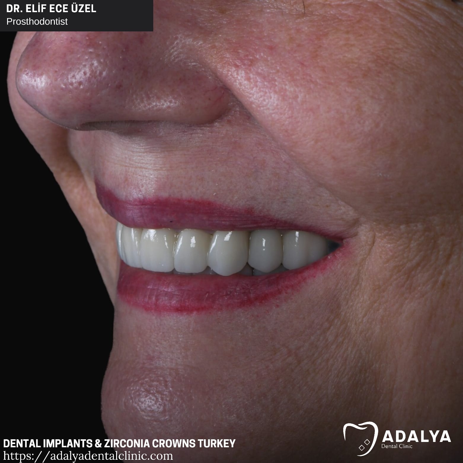 Adalya Zahn Zahnimplantate Antalya Türkei Einstandspreise