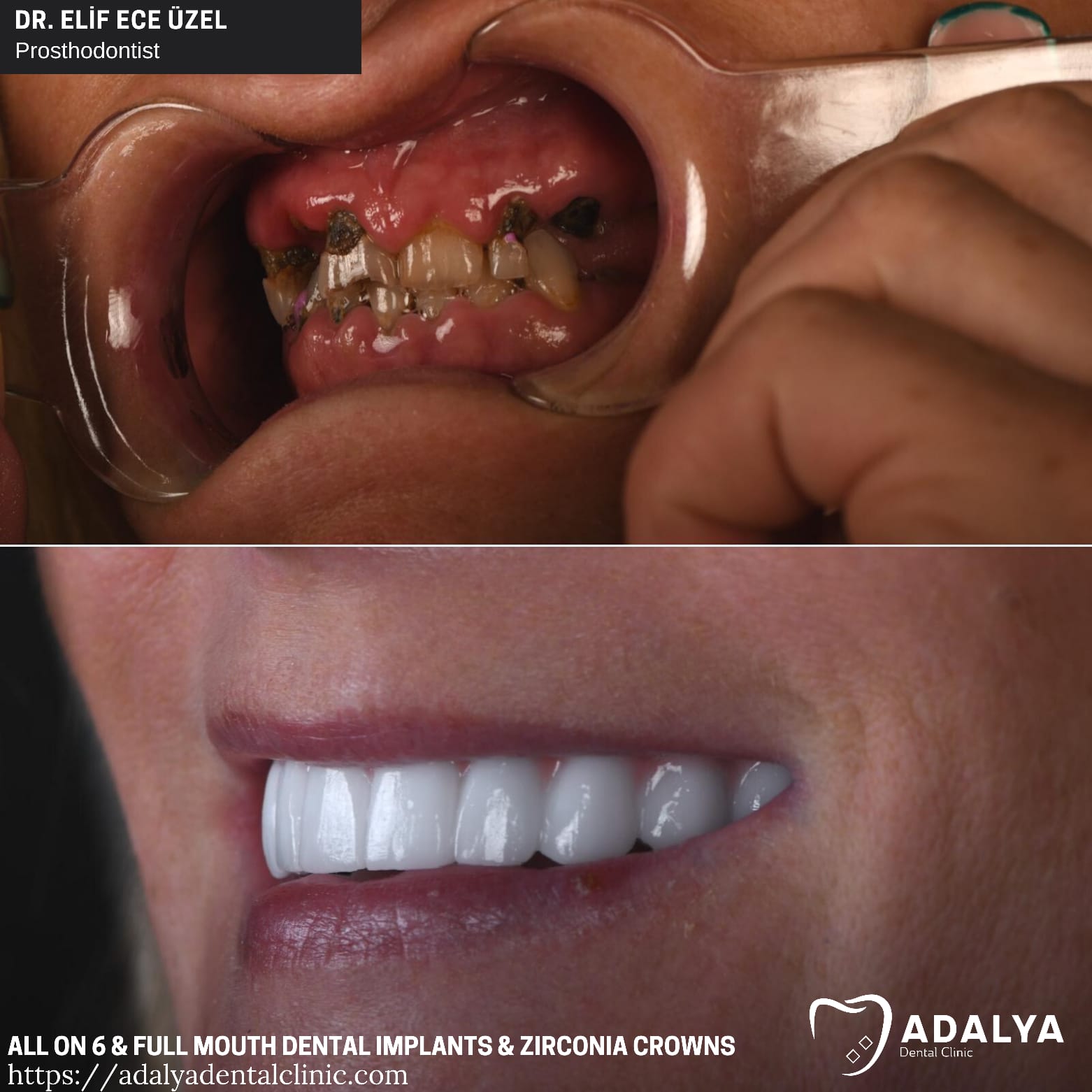 Vollmund-Zahnimplantate Truthahn Paketangebote Einstandspreis Bewertungen Antalya Zähne
