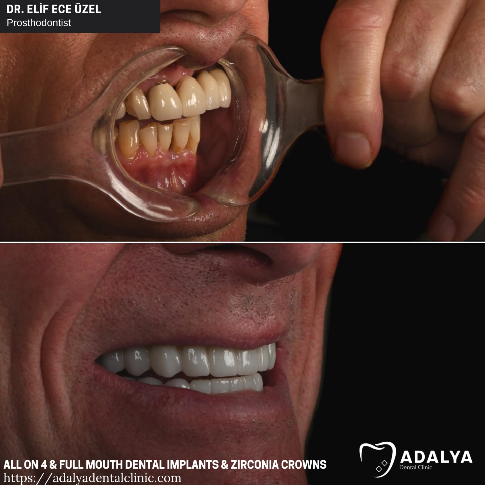 full mouth dental implants turkey package deals cost price reviews antalya tooth
