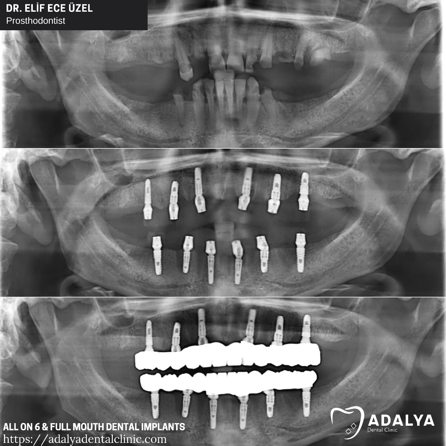Vollmund-Zahnimplantate Truthahn Paketangebote Preis Kosten Bewertungen Antalya Zähne