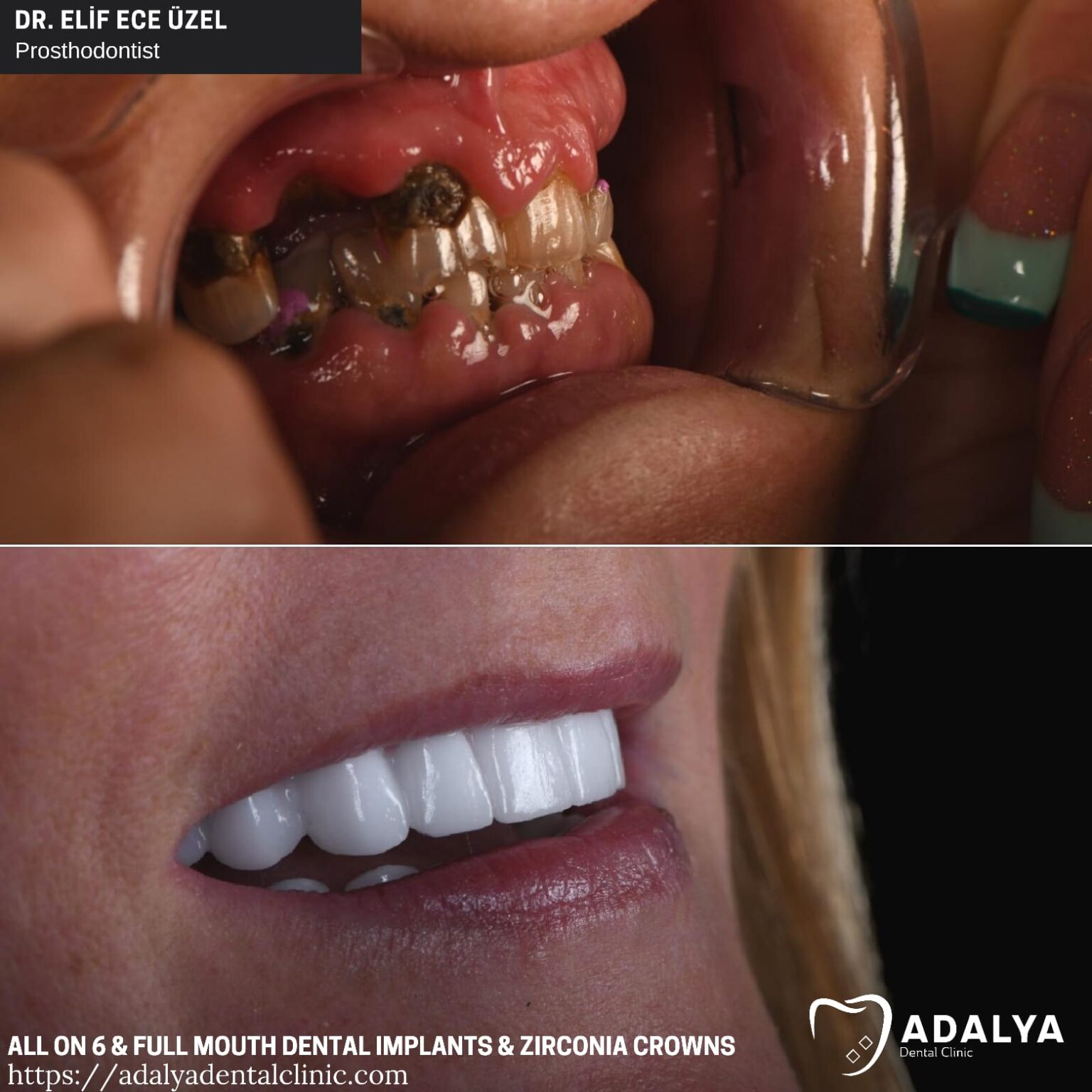 Full Mouth Dental Implants Turkey Package Deals Full Set Implants Cost