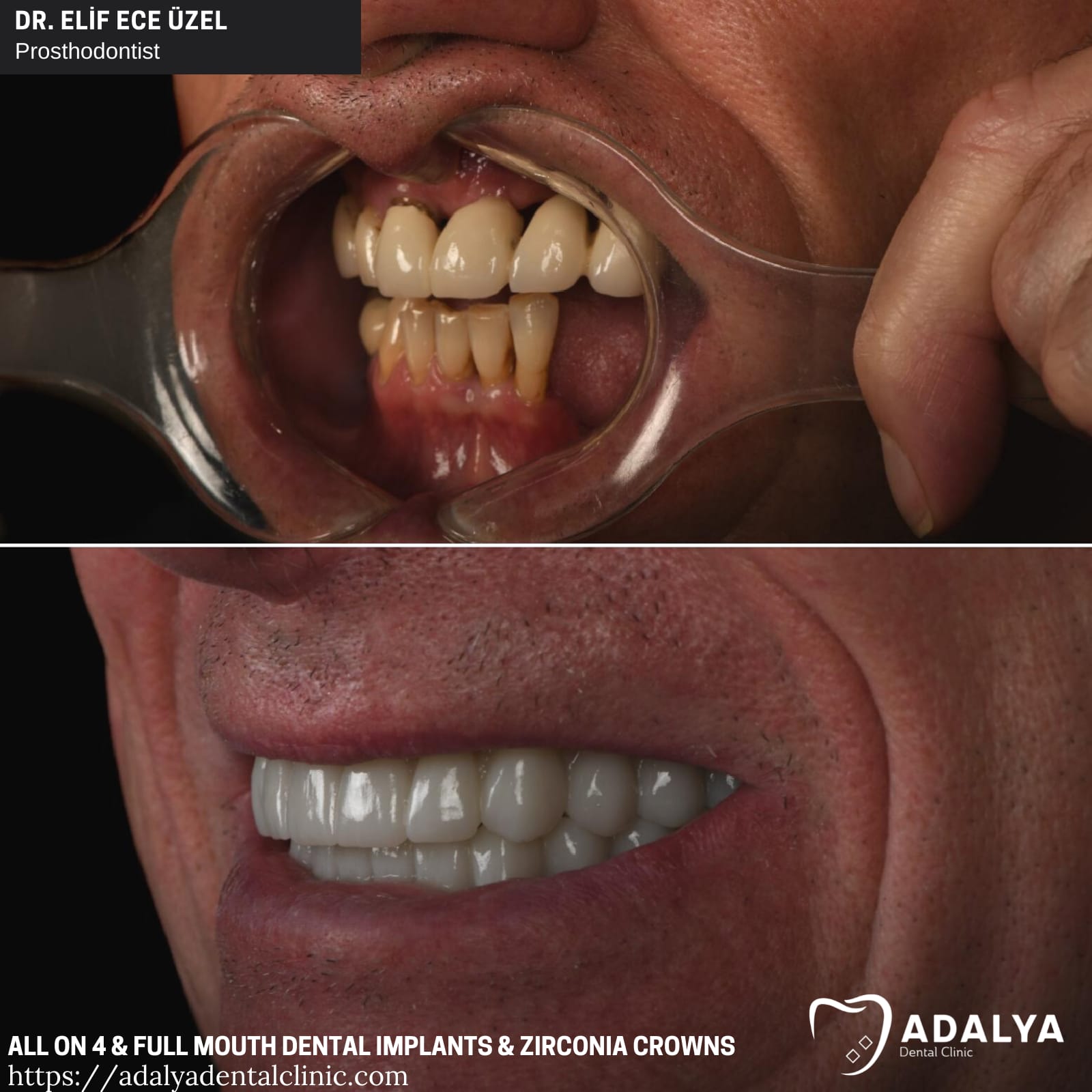 full mouth dental implants turkey package deals reviews cost price antalya tooth