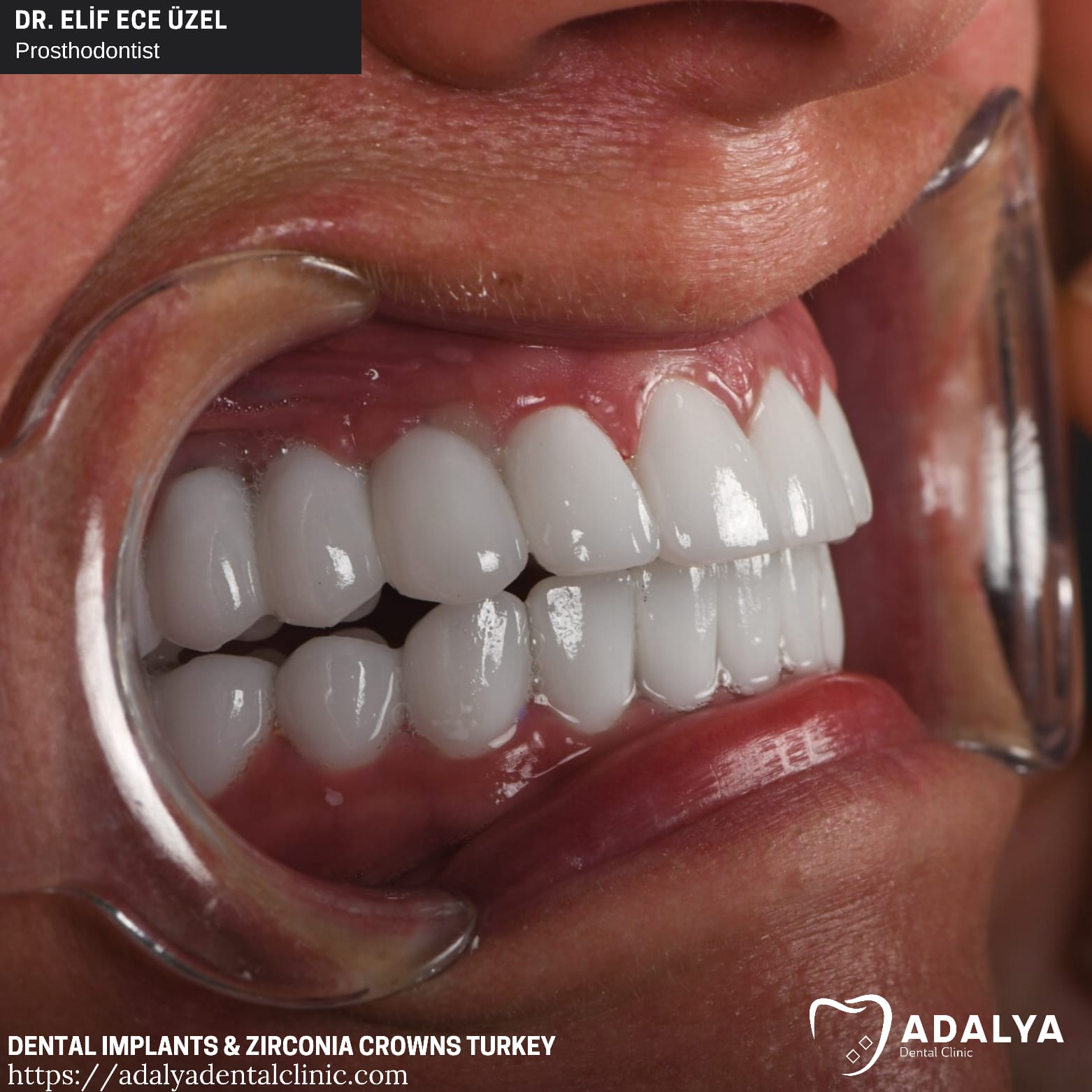 best dental implant clinic turkey antalya cost price istanbul