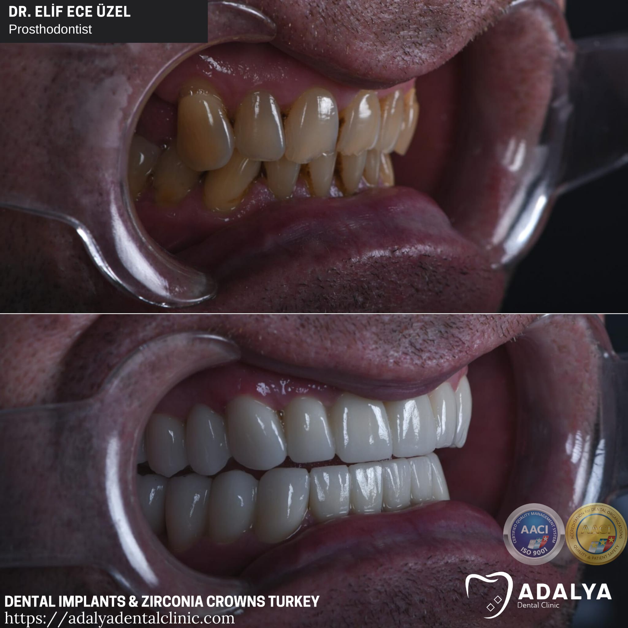 zirconium crowns dental implants turkey antalya packages cost
