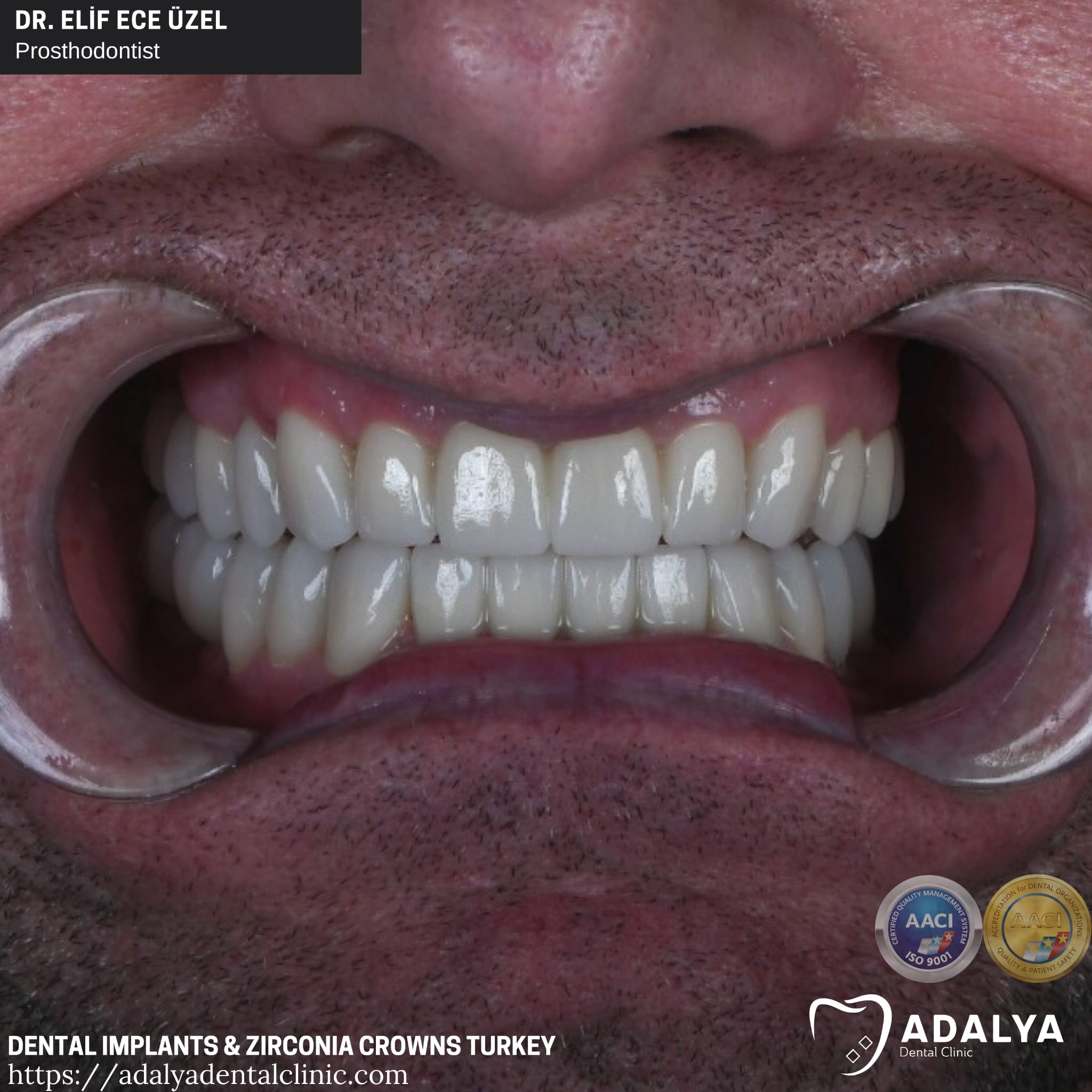 zirconium crowns dental implants turkey antalya packages prices