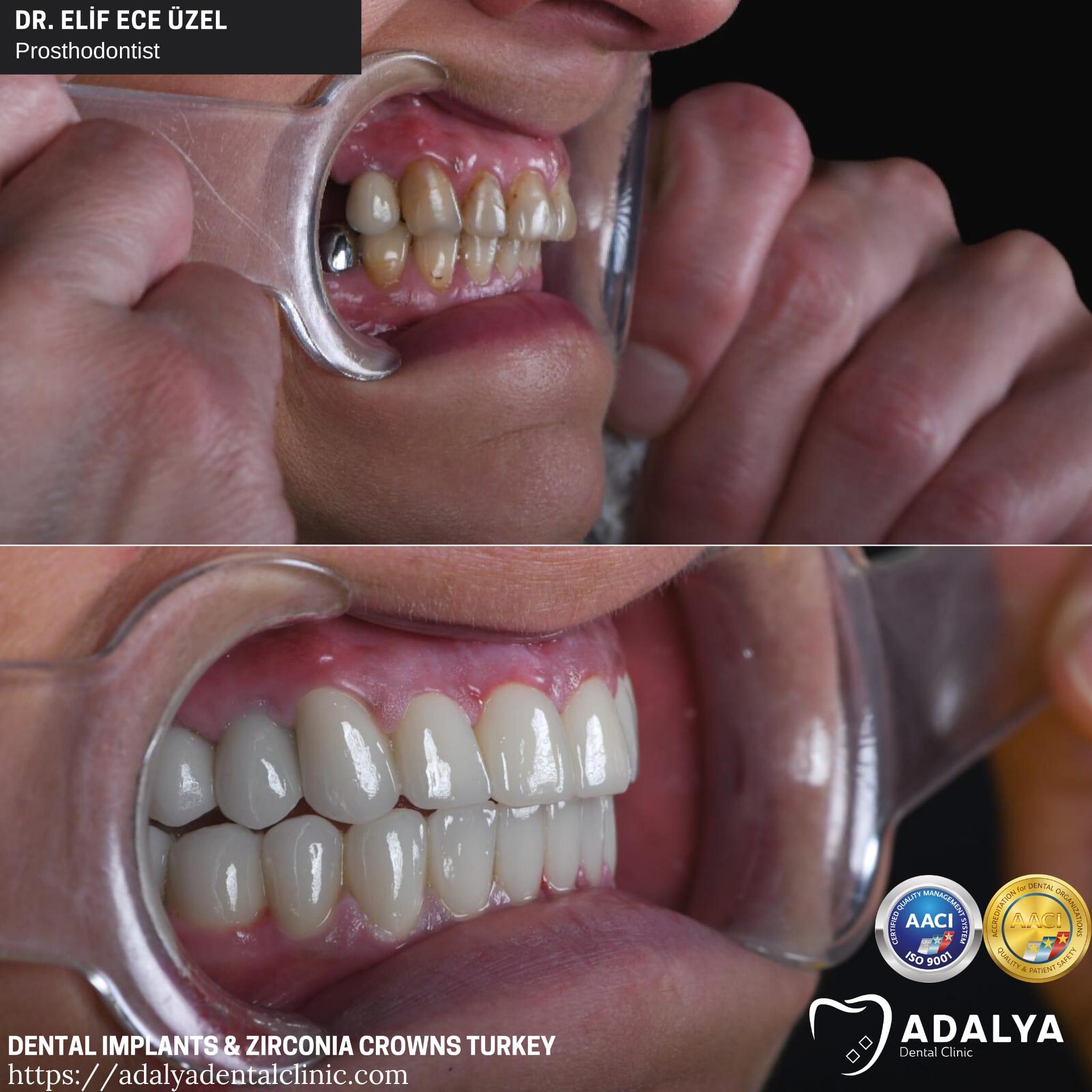 tooth dental implants turkey antalya prices cost