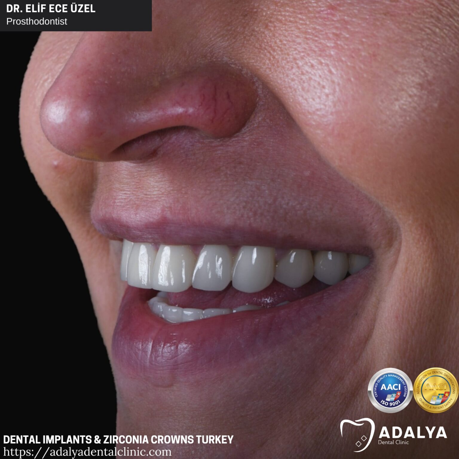 Dental Implants in Turkey, Antalya Best Brands At Affordable Cost