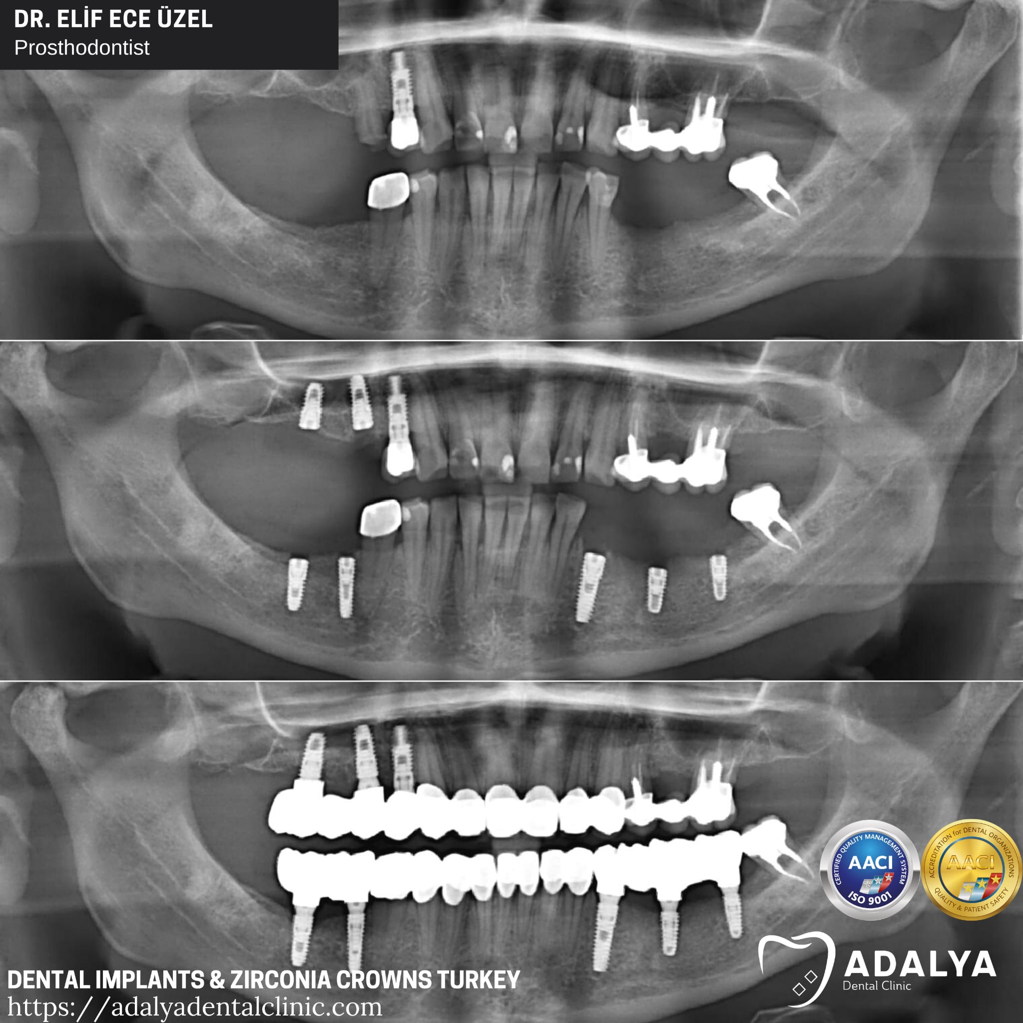 turkey teeth implants antalya prices cost packages istanbul