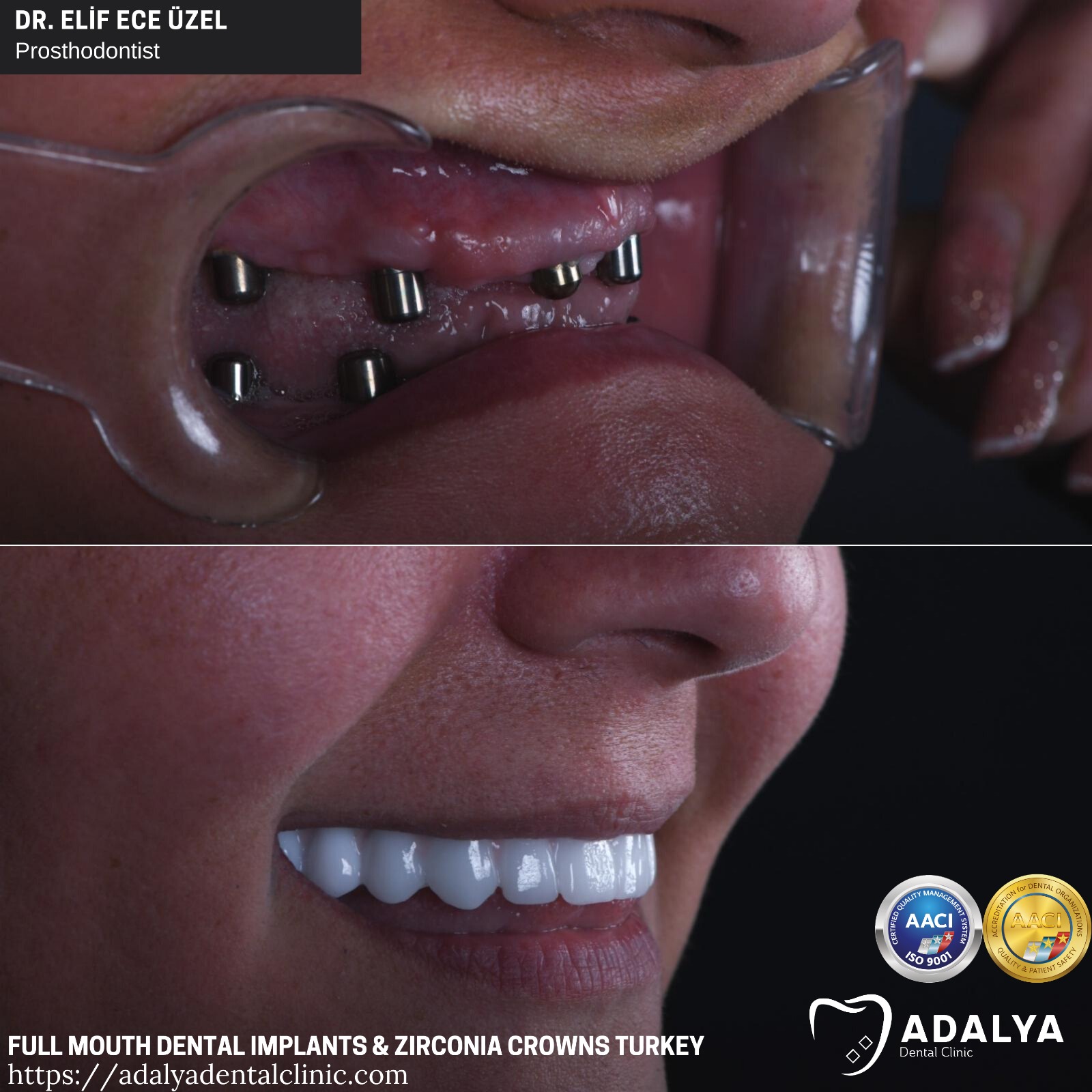 Truthahnzähne Implantate Dental Antalya Kostenpakete überprüfen