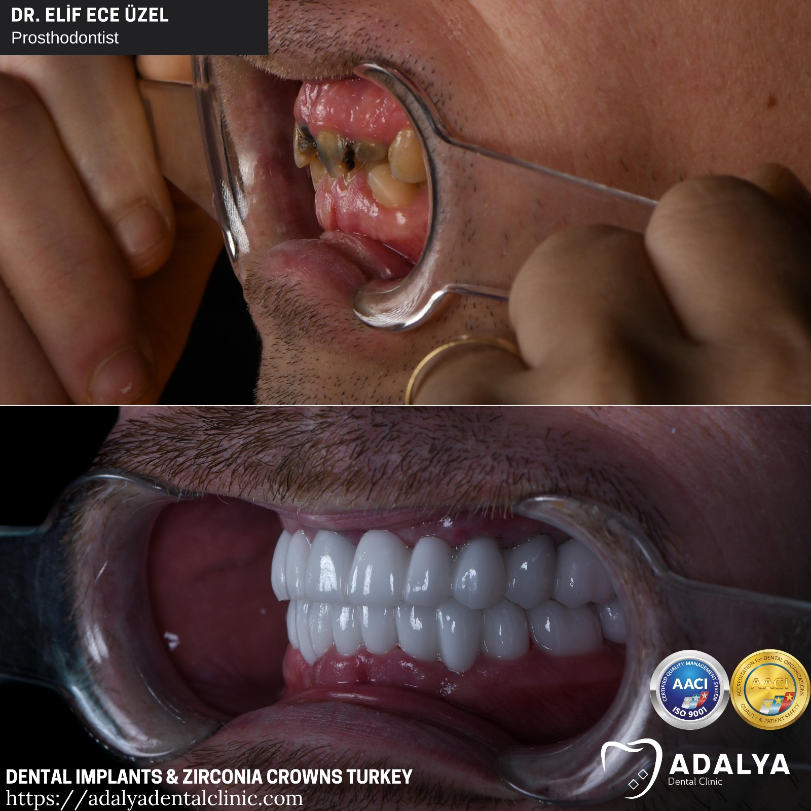 dental clinic turkey dentist teeth tooth antalya prices cost packages