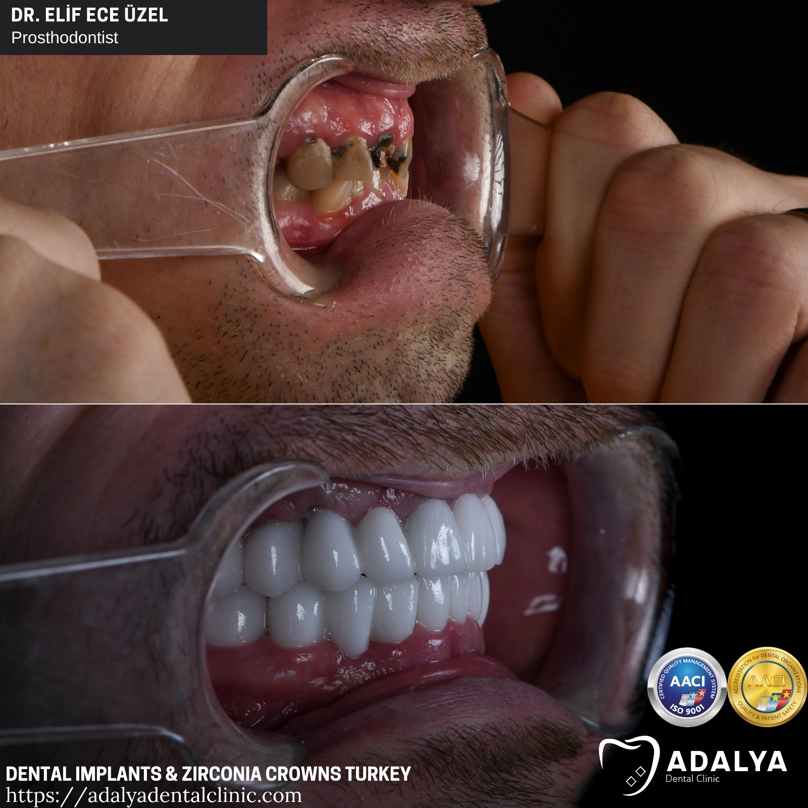 dental clinic turkey teeth tooth dentist antalya prices cost packages