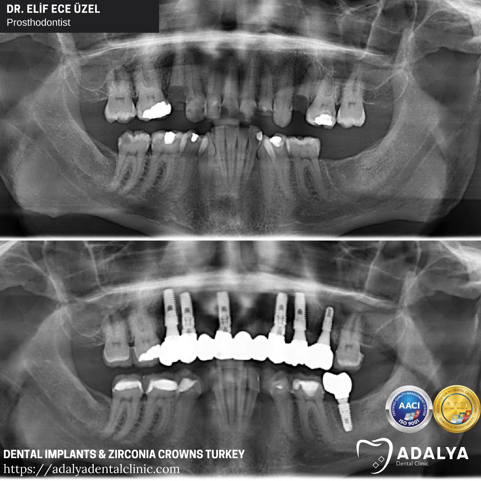 dental implants clinic turkey teeth dentist tooth antalya prices cost packages