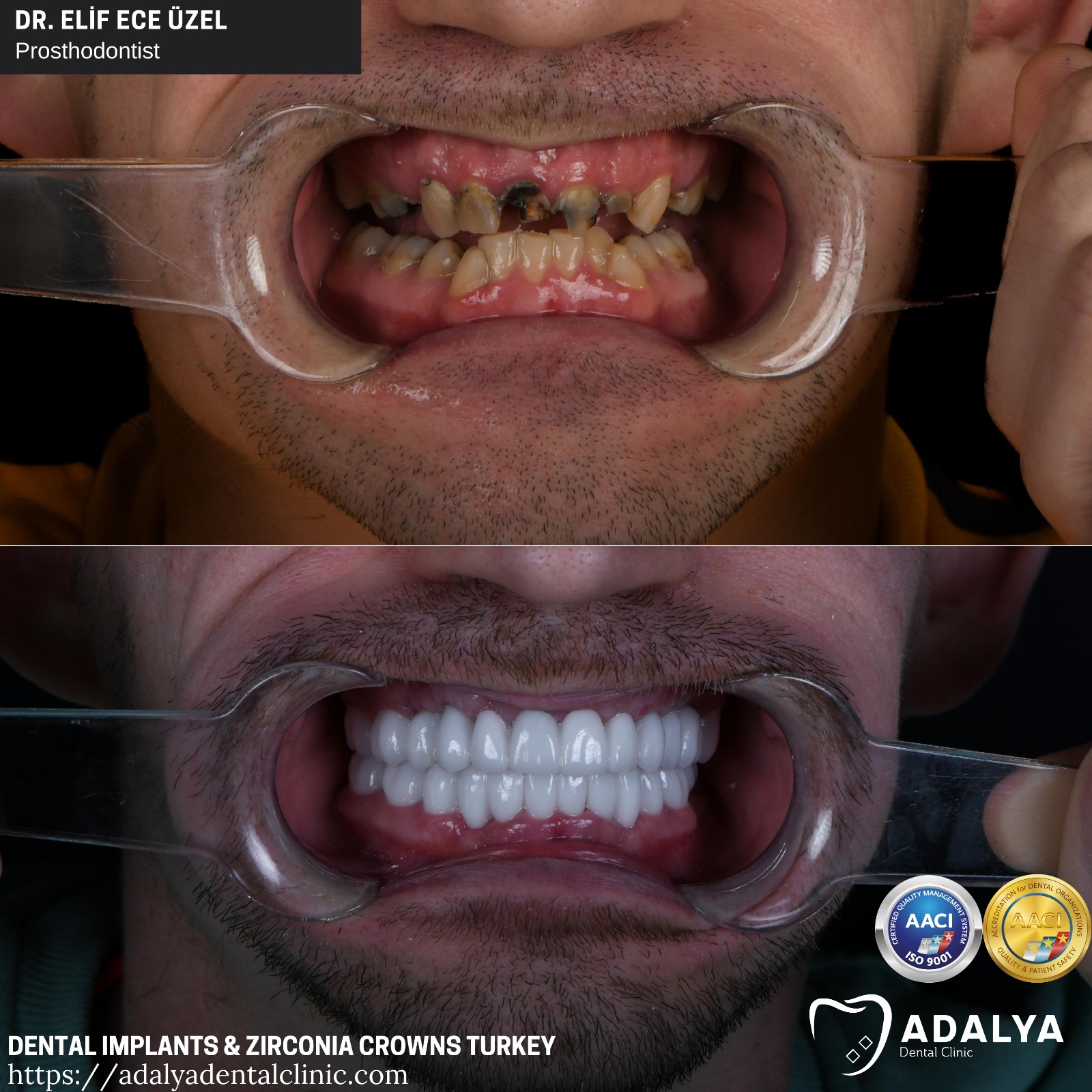 dentdental clinic turkey teeth tooth antalya prices cost packages istanbul