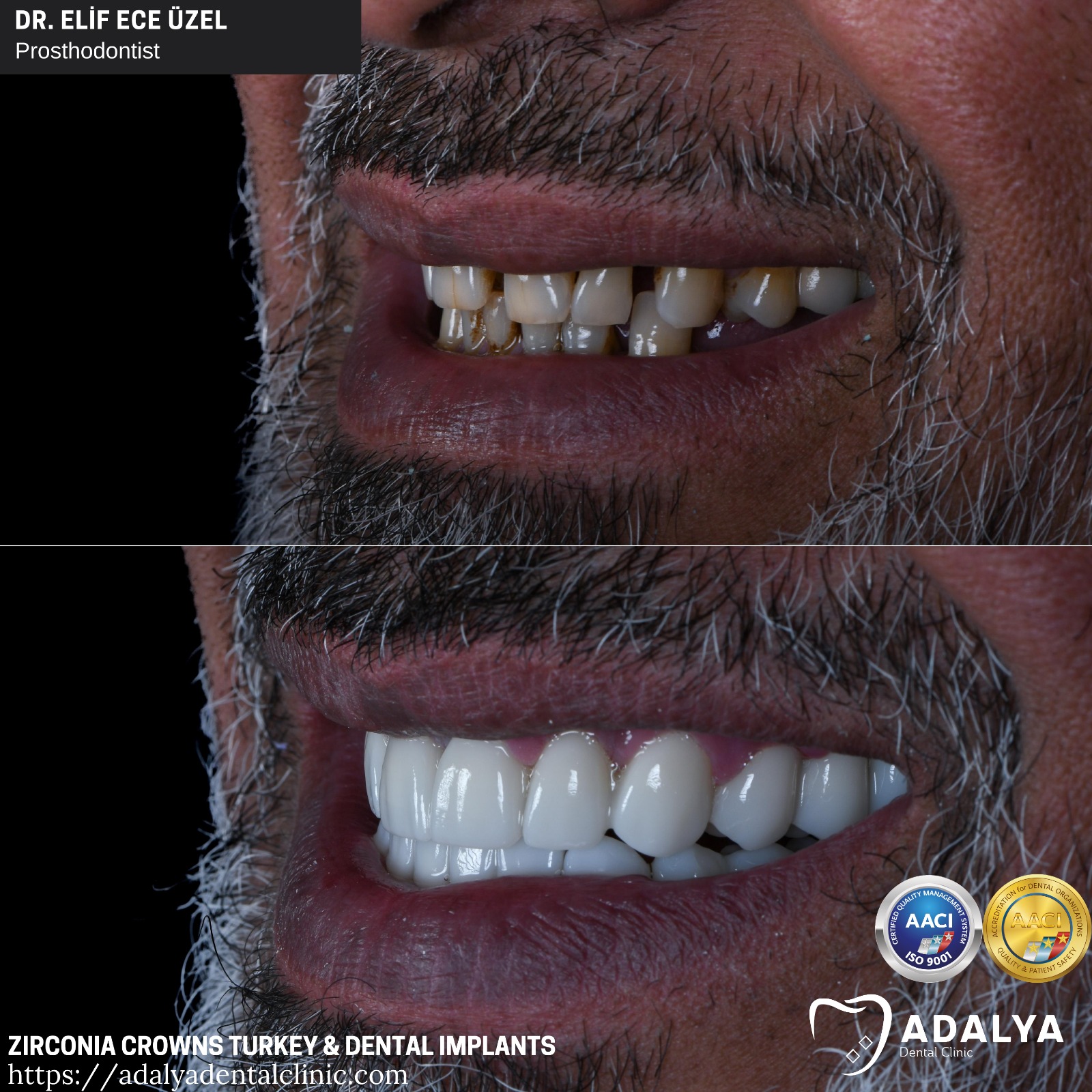 dental clinic antalya turkey zirconia crowns tooth implants cost packages price