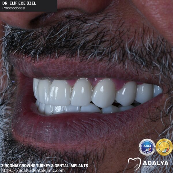 Dentistry Turkey Cosmetic Dentistry Antalya Adalya Dental Clinic