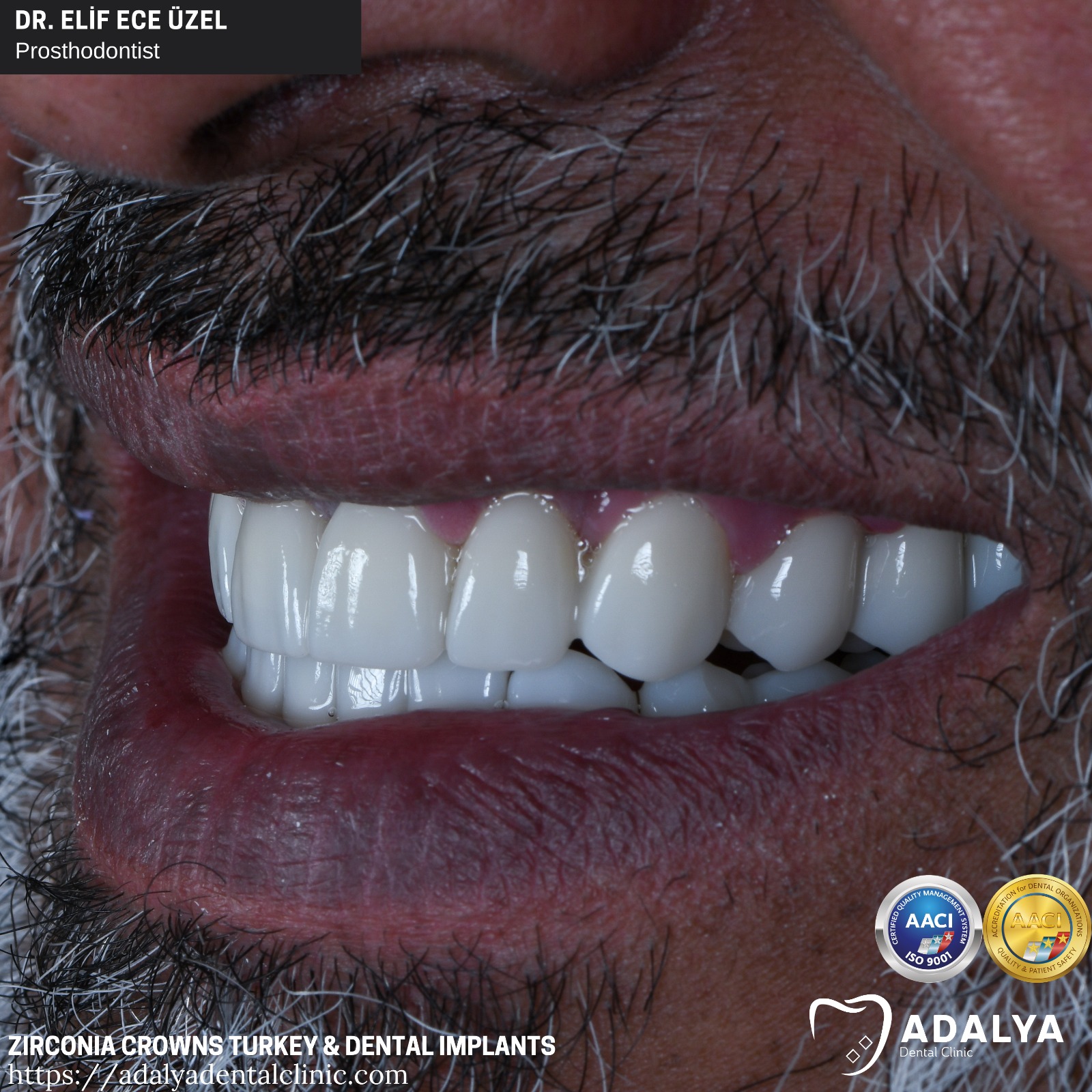 dental clinic antalya turkey zirconium crowns tooth implants cost packages price