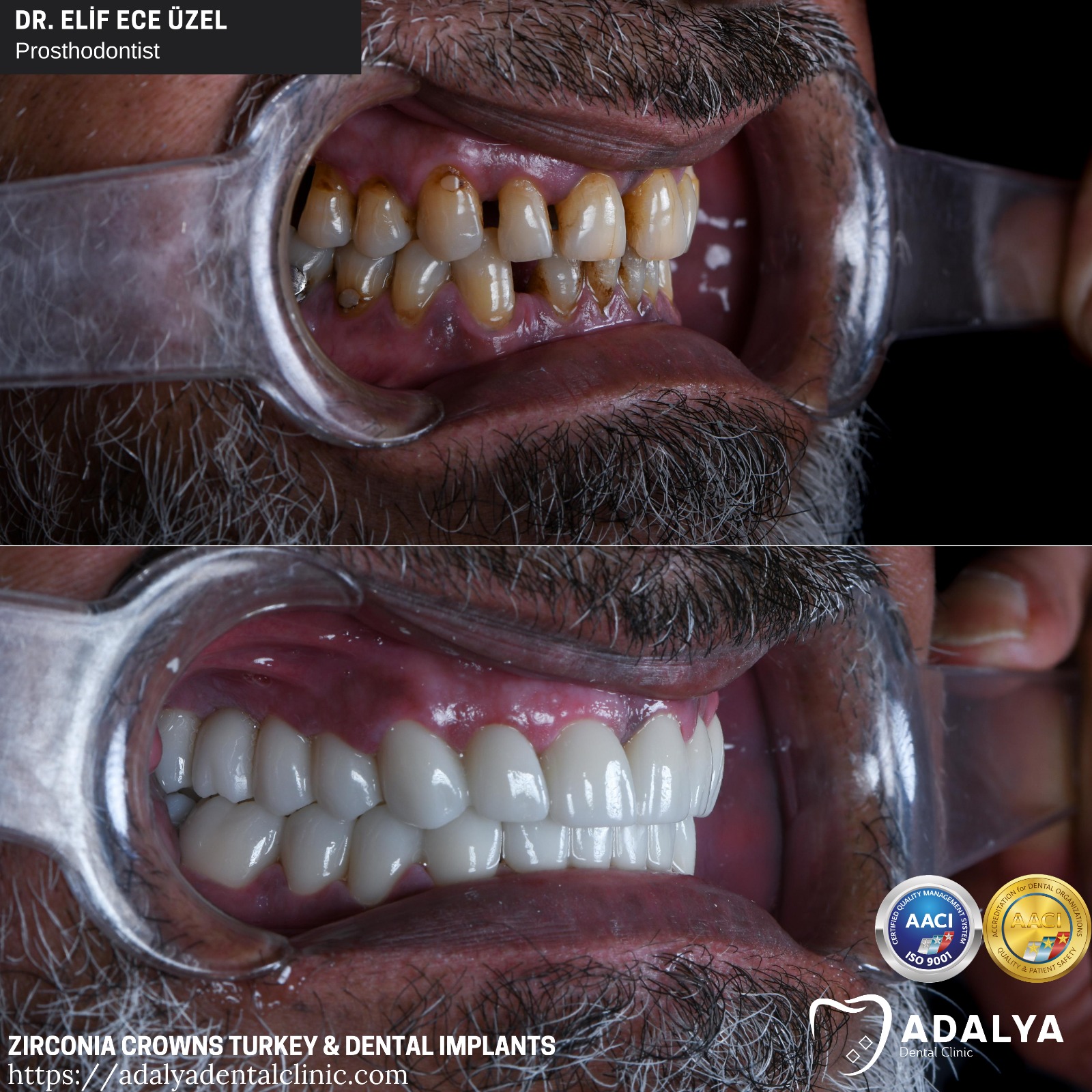 dental clinic turkey antalya zirconia crowns tooth implants cost packages price