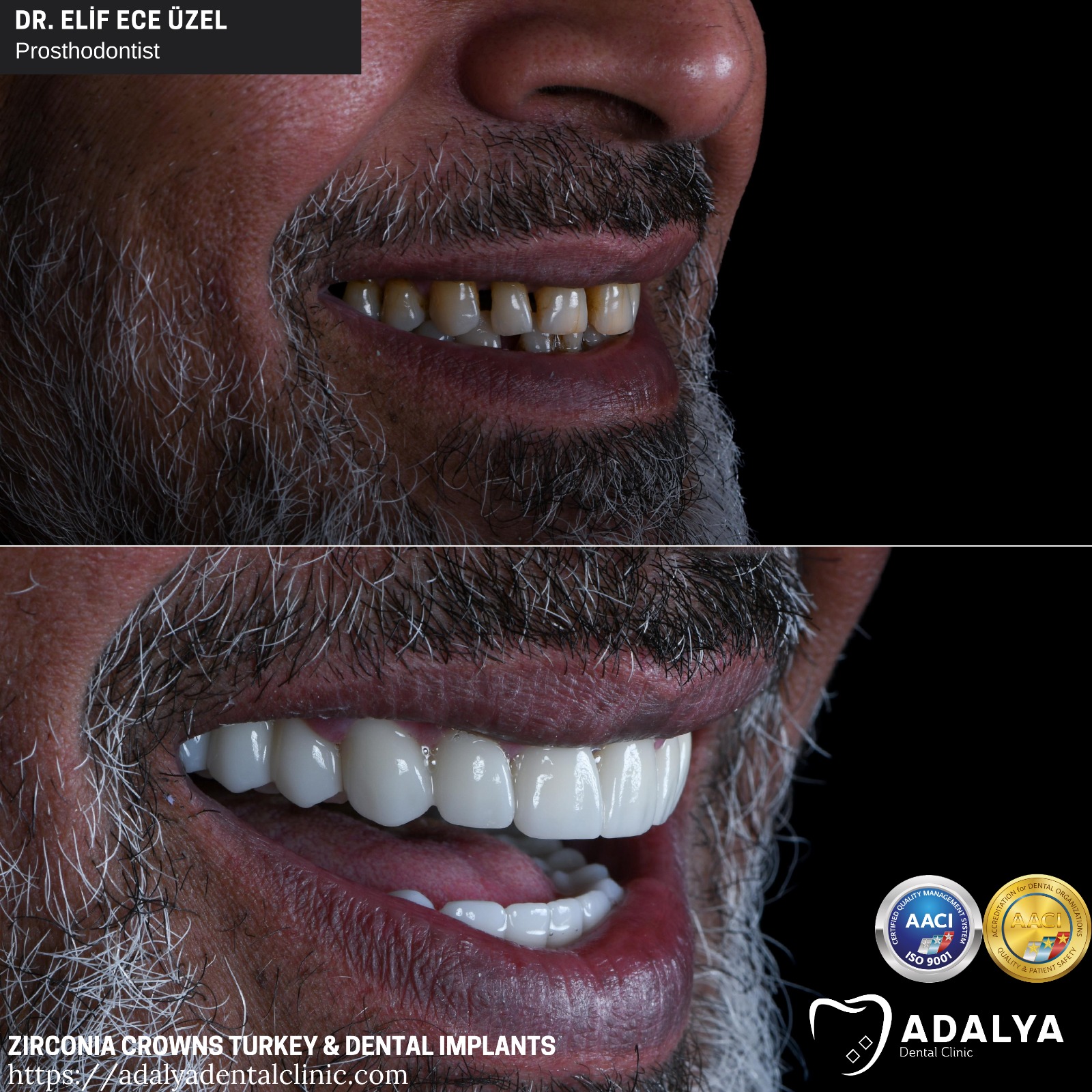 dental clinic turkey antalya zirconia crowns tooth implants cost price packages
