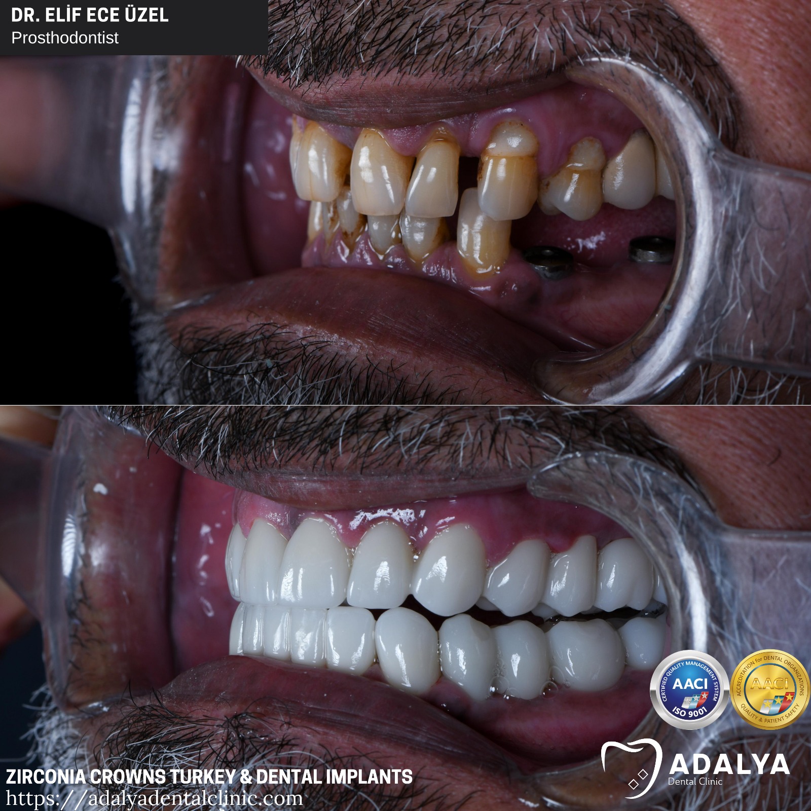 dental clinic turkey antalya zirconia crowns tooth implants price packages cost
