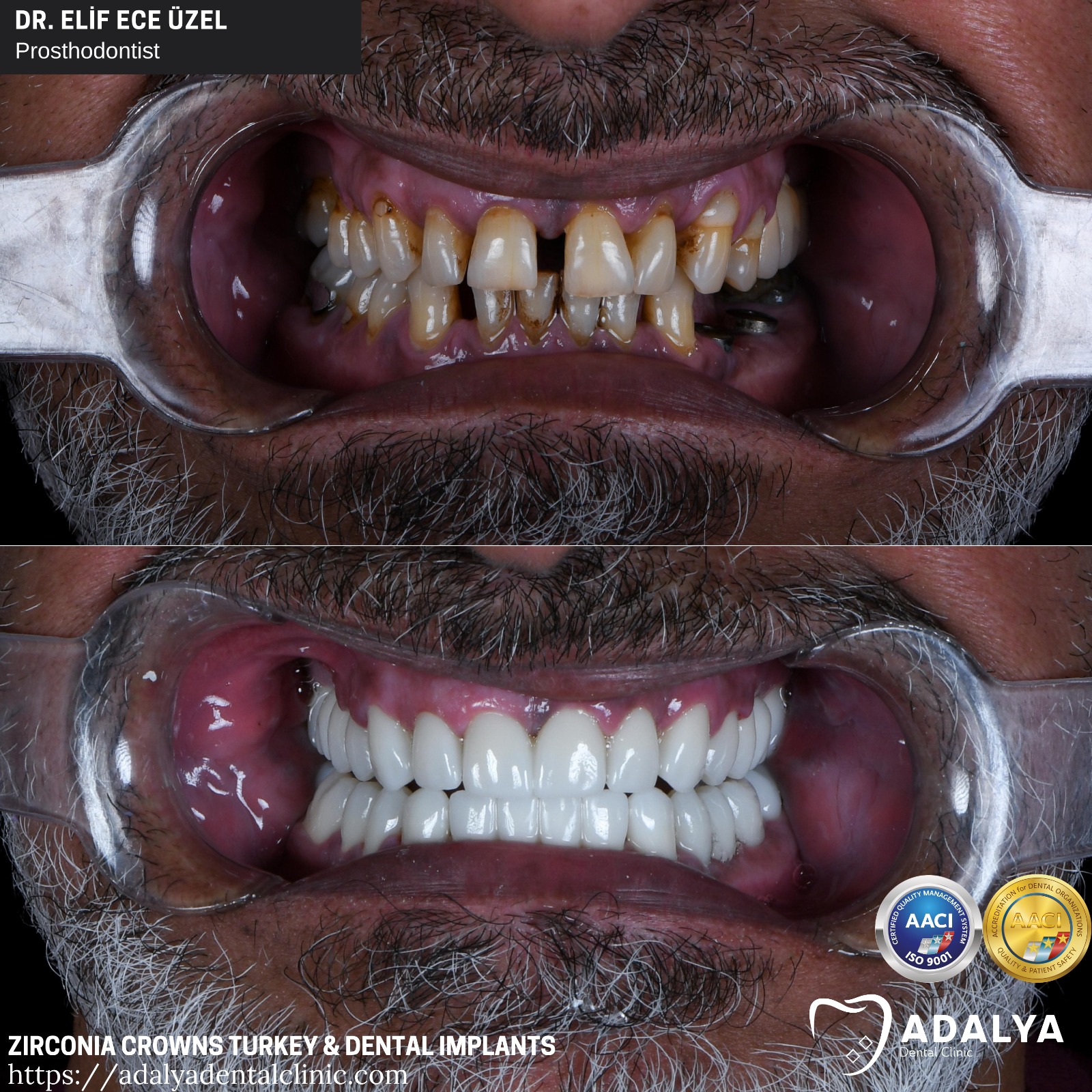 dental clinic turkey antalya zirconium crowns tooth implants cost price packages