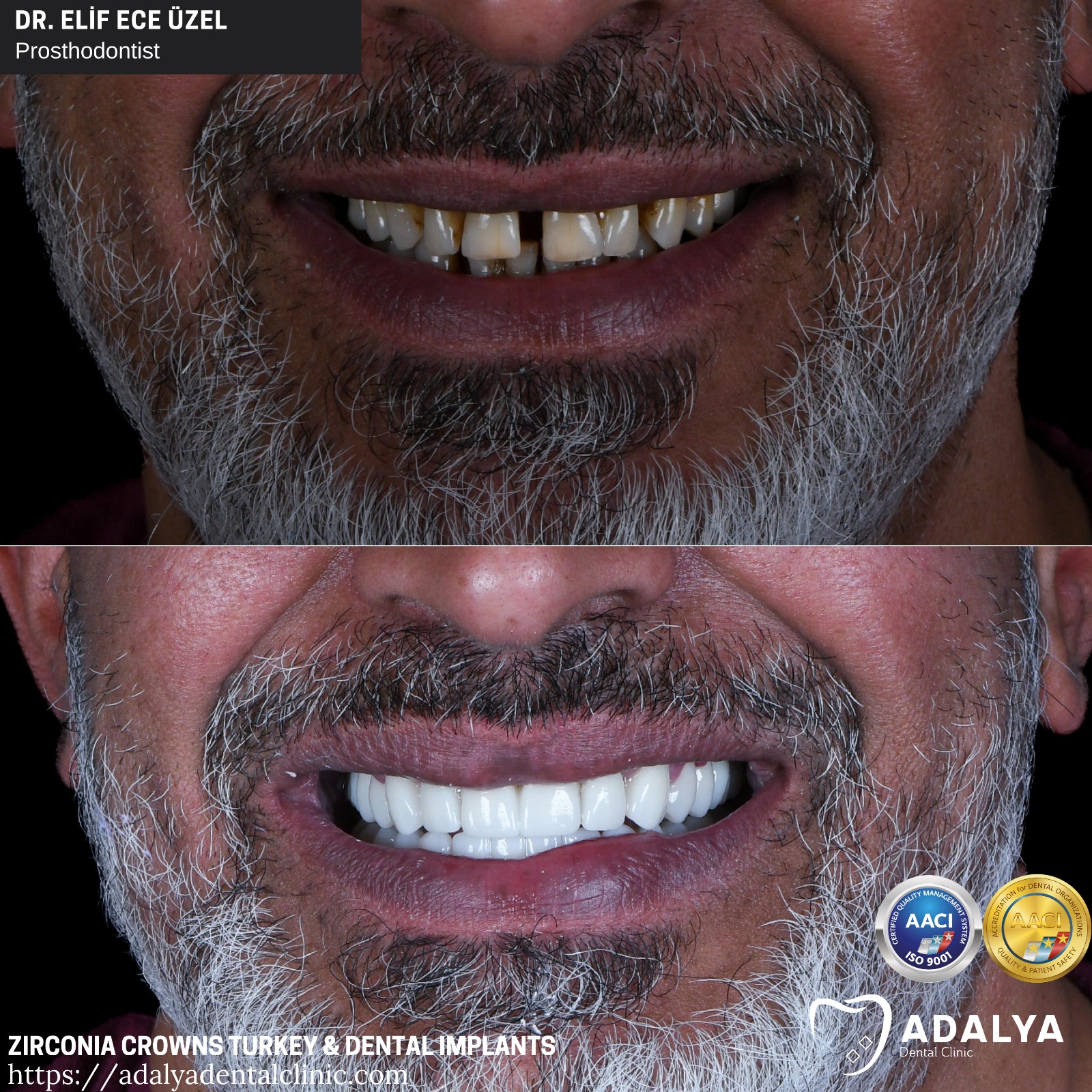 dental clinic turkey antalya zirconium crowns tooth implants price packages cost