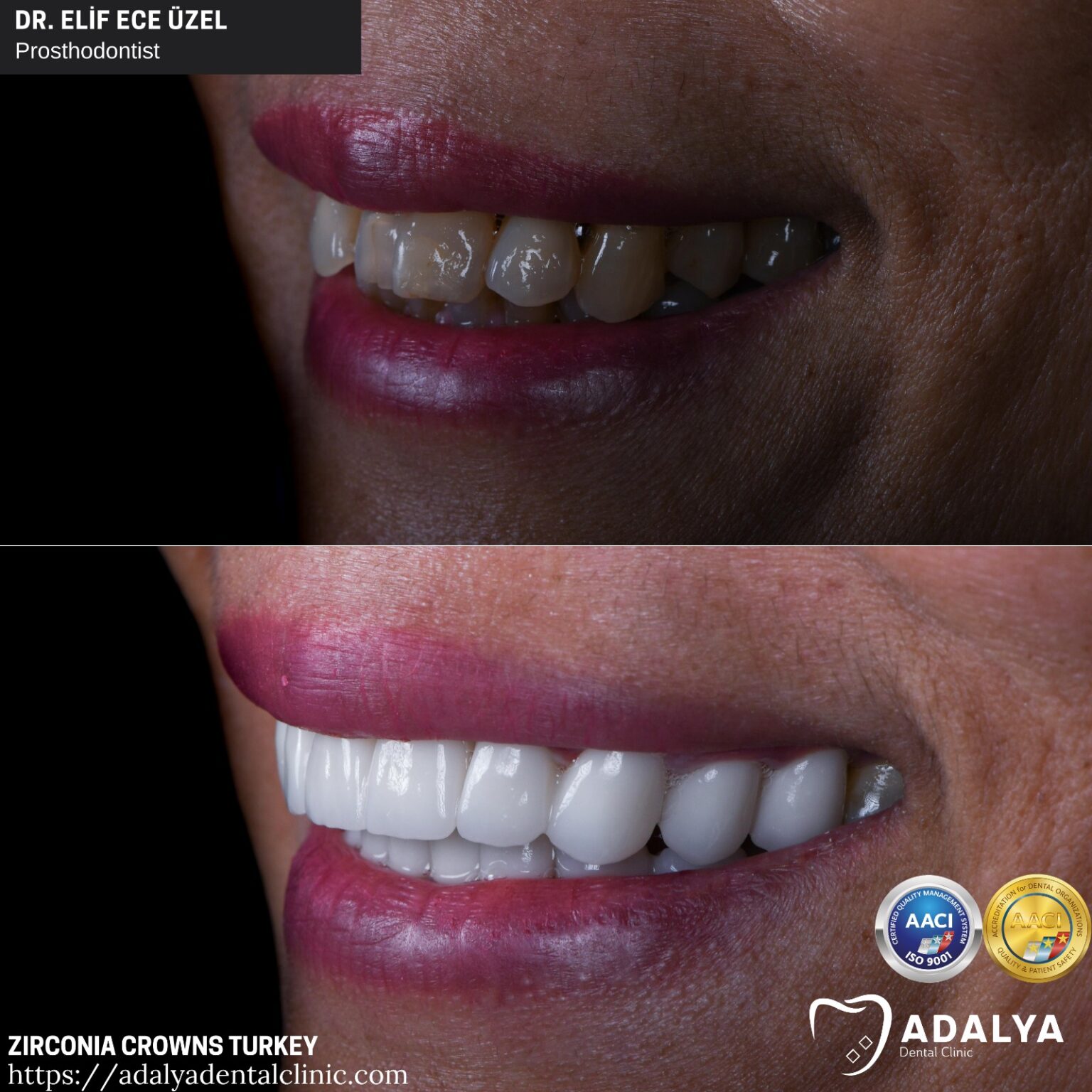 Dentistry Turkey Cosmetic Dentistry Antalya Adalya Dental Clinic