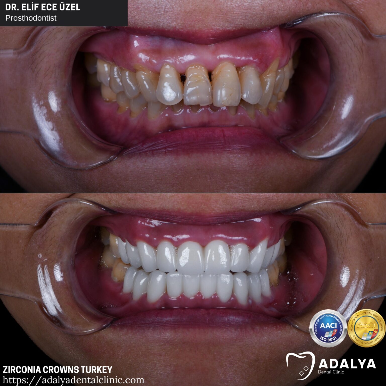 Dentistry Turkey Cosmetic Dentistry Antalya Adalya Dental Clinic