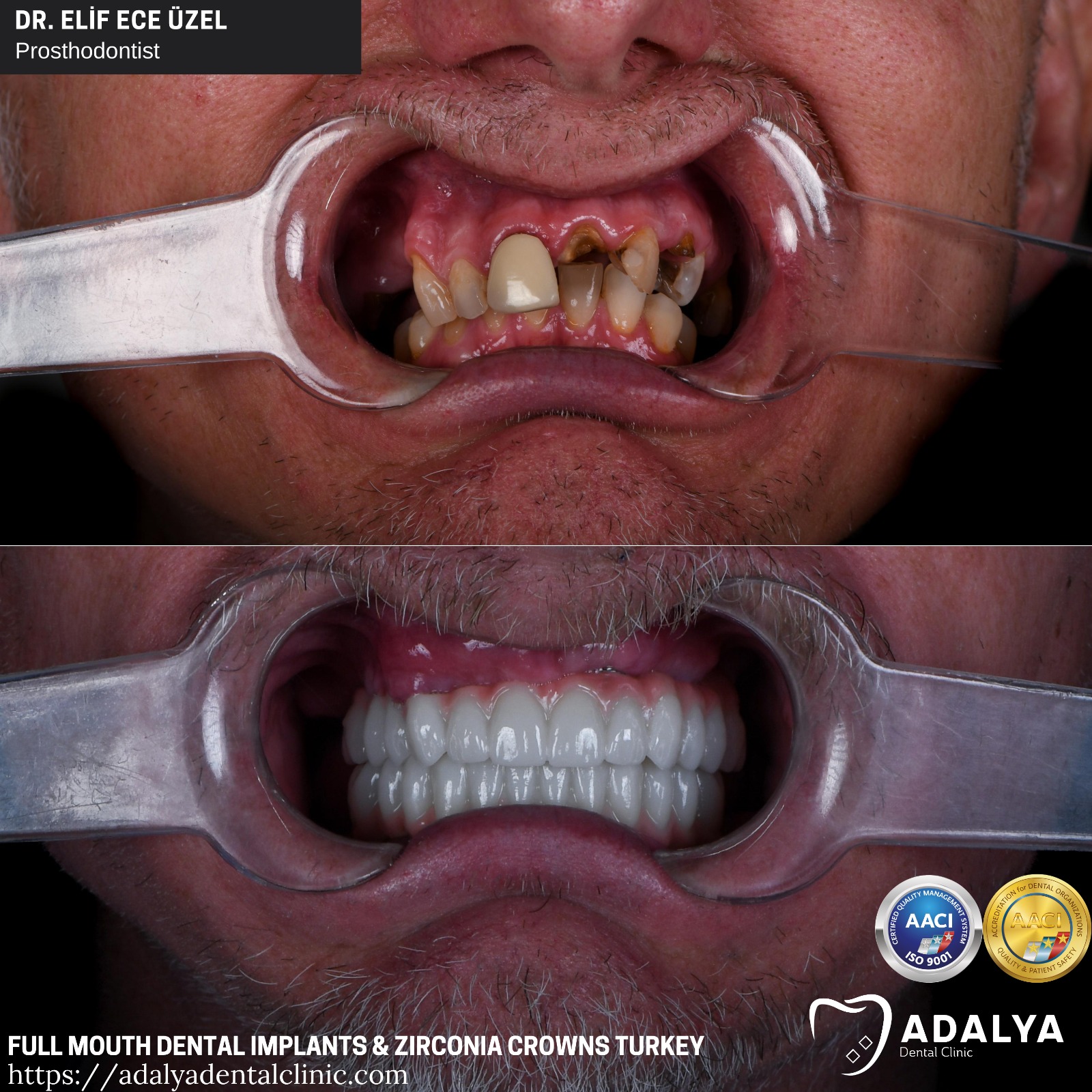 full mouth all on 6 5 dental implants turkey antalya package cost price tooth