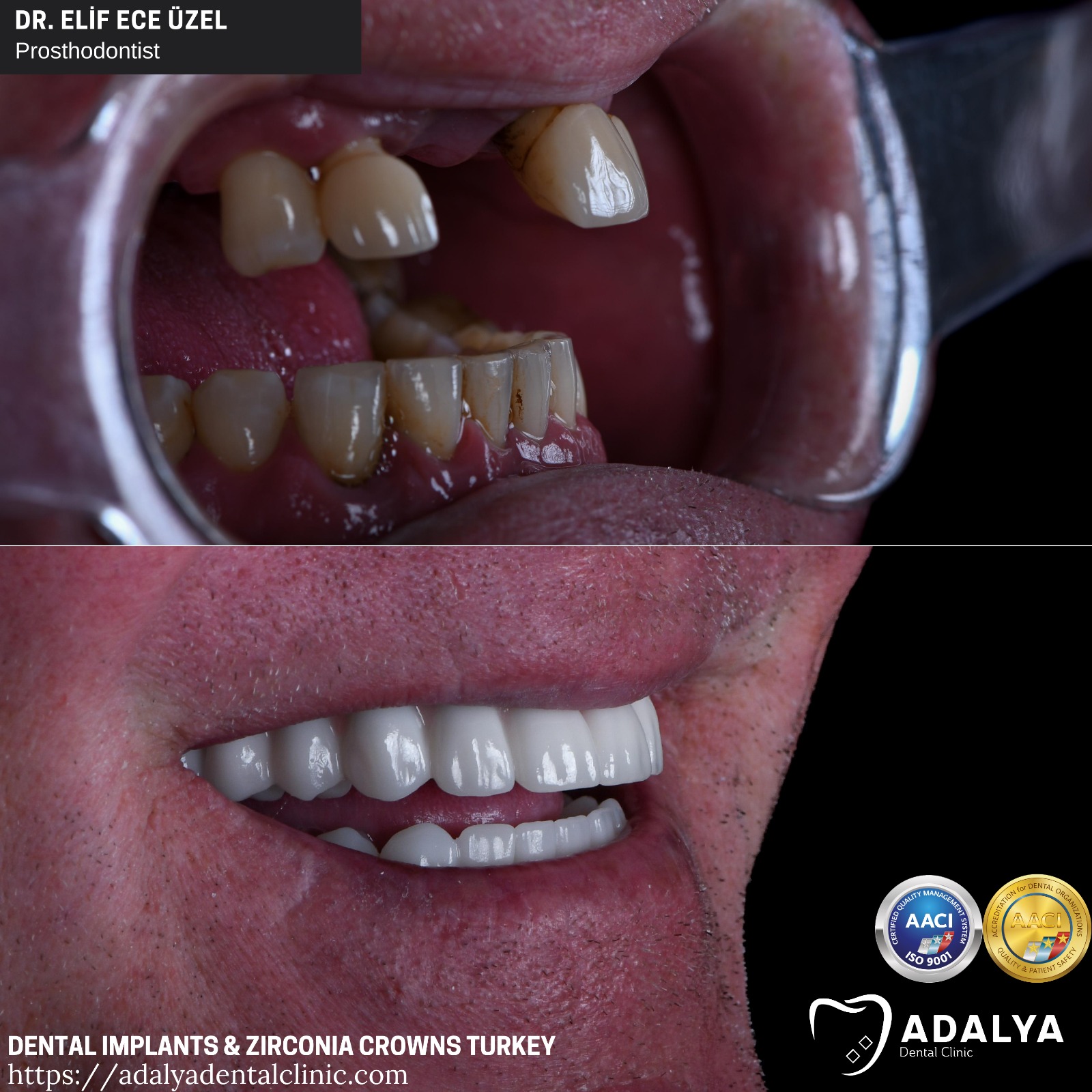 full set of dental implants turkey antalya zirconium crowns cost price packages