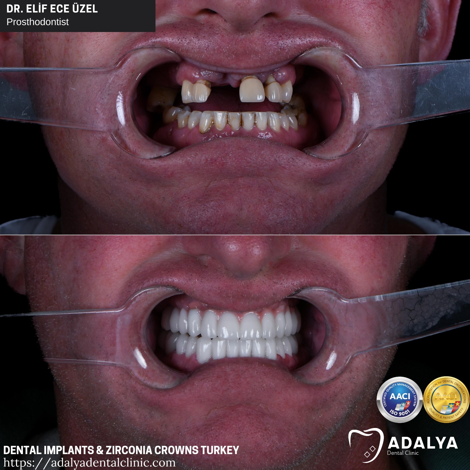 full set of dental implants turkey antalya zirconium crowns packages price cost