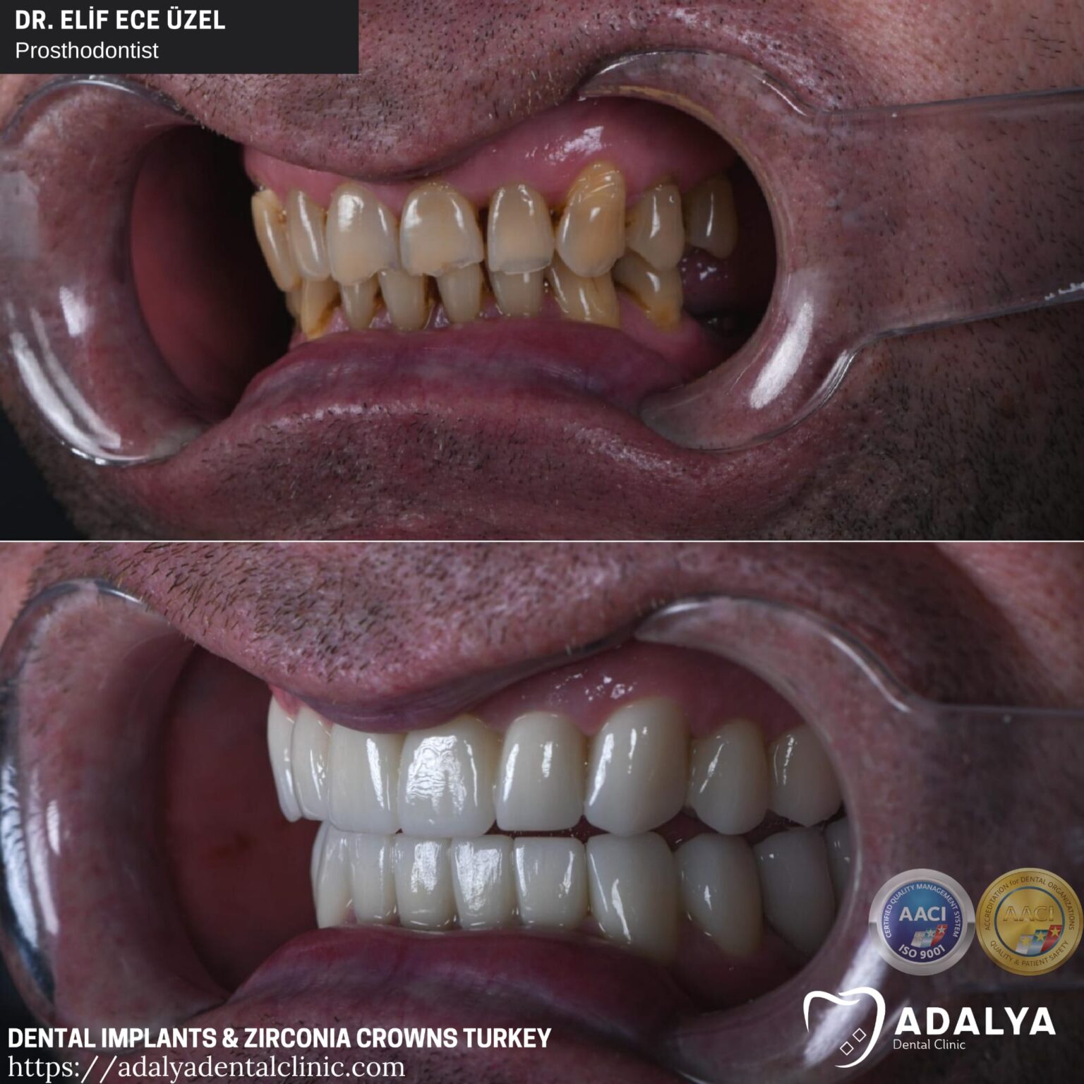 Dental Implants Turkey Antalya Best Brands At Affordable Cost