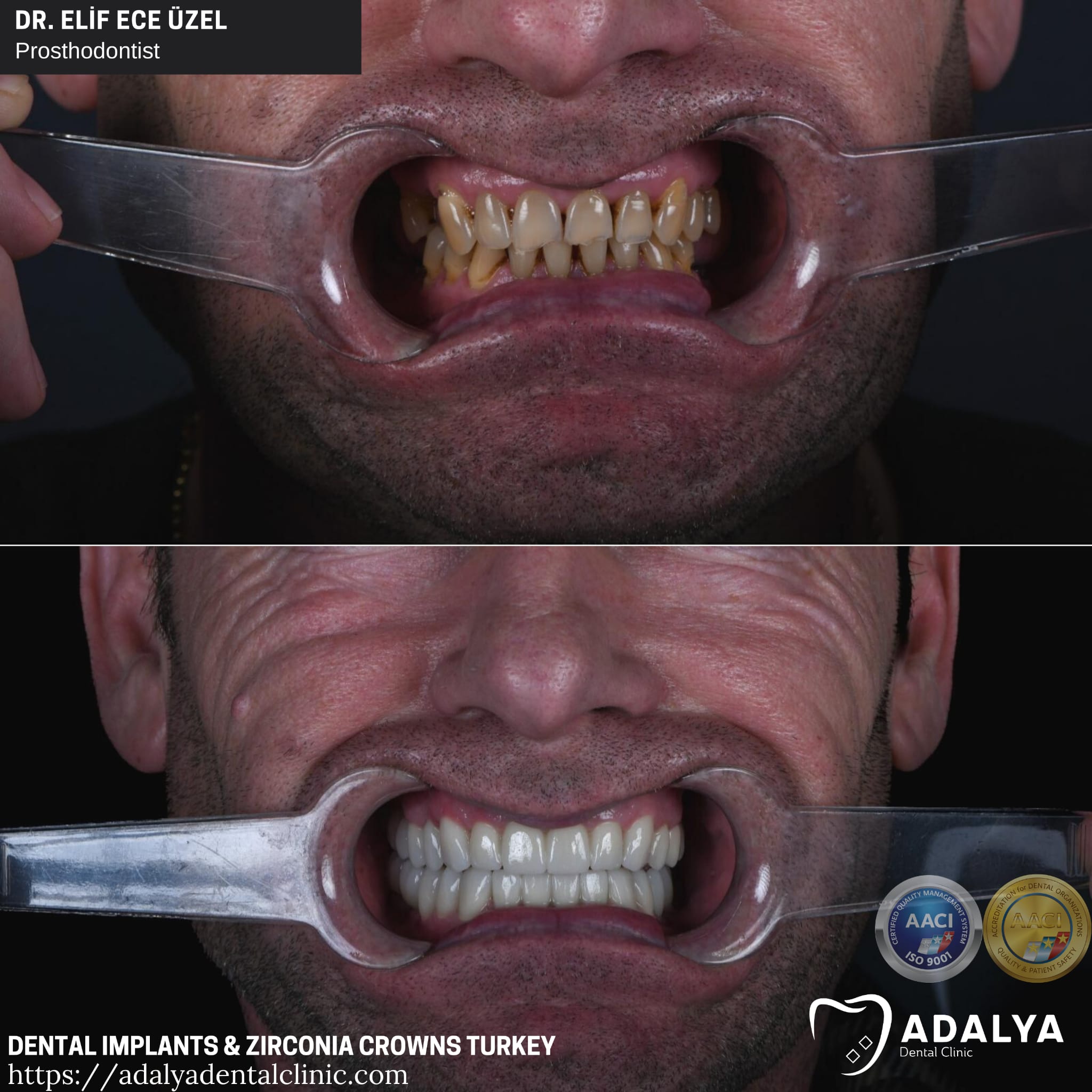 dental implants antalya turkey price cost packages adalya
