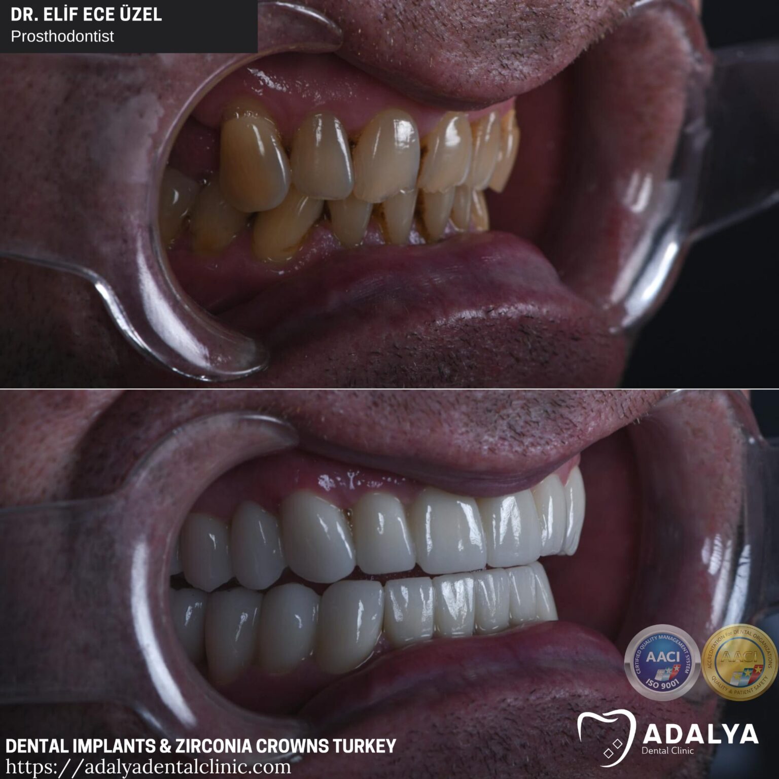 Dental Implants Turkey Antalya Best Brands At Affordable Cost
