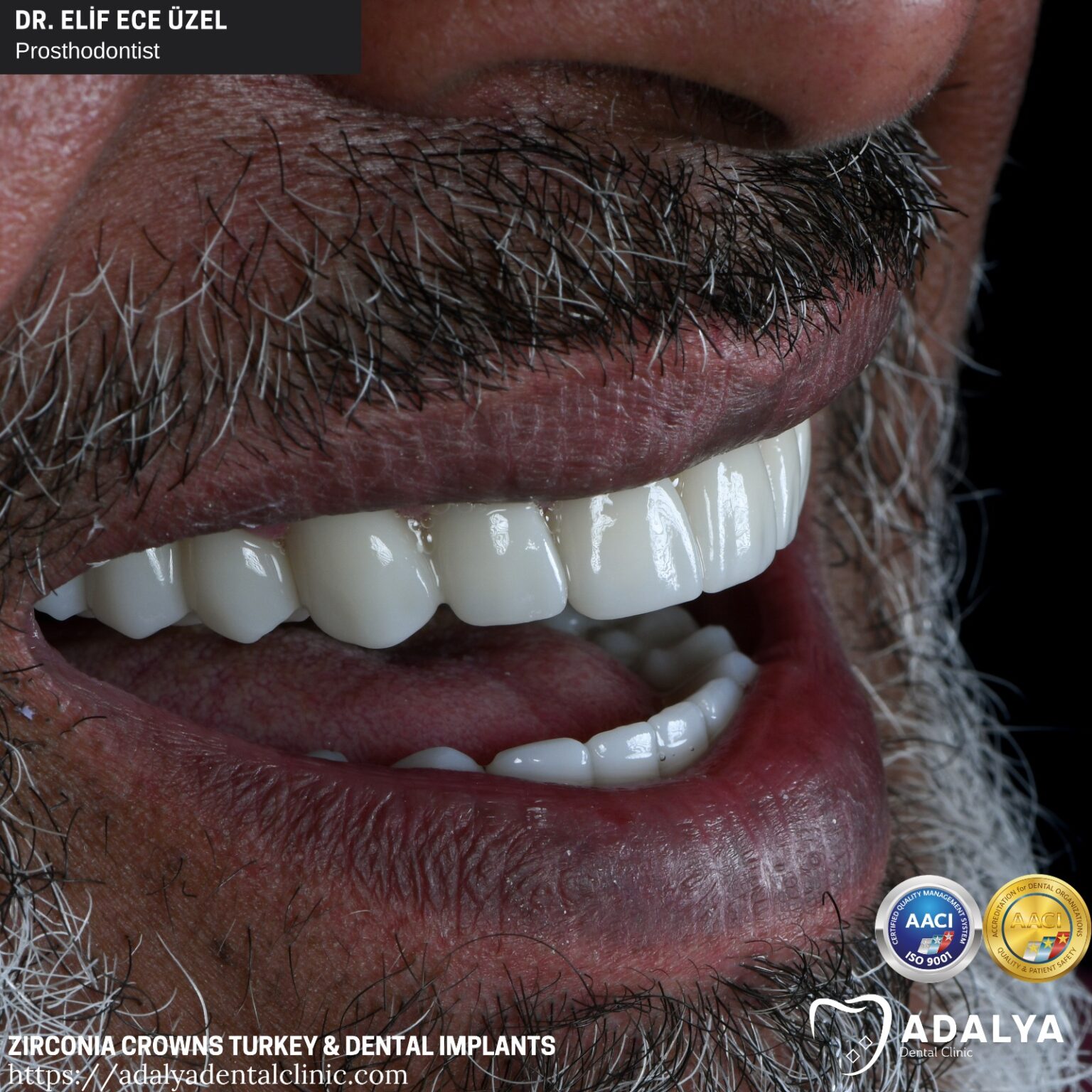 Dental Implants in Turkey, Antalya Best Brands At Affordable Cost