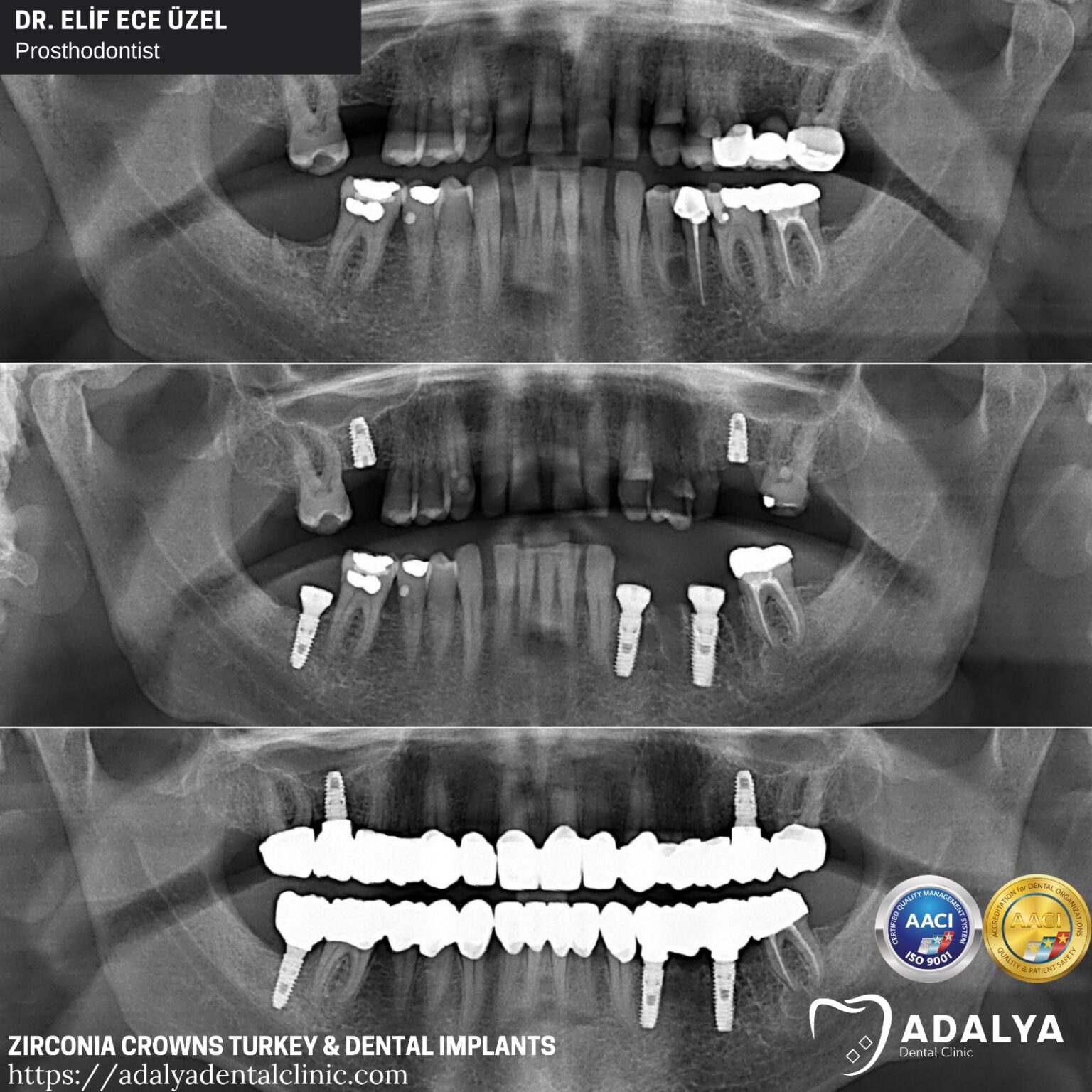 Dental Implants in Turkey, Antalya Best Brands At Affordable Cost