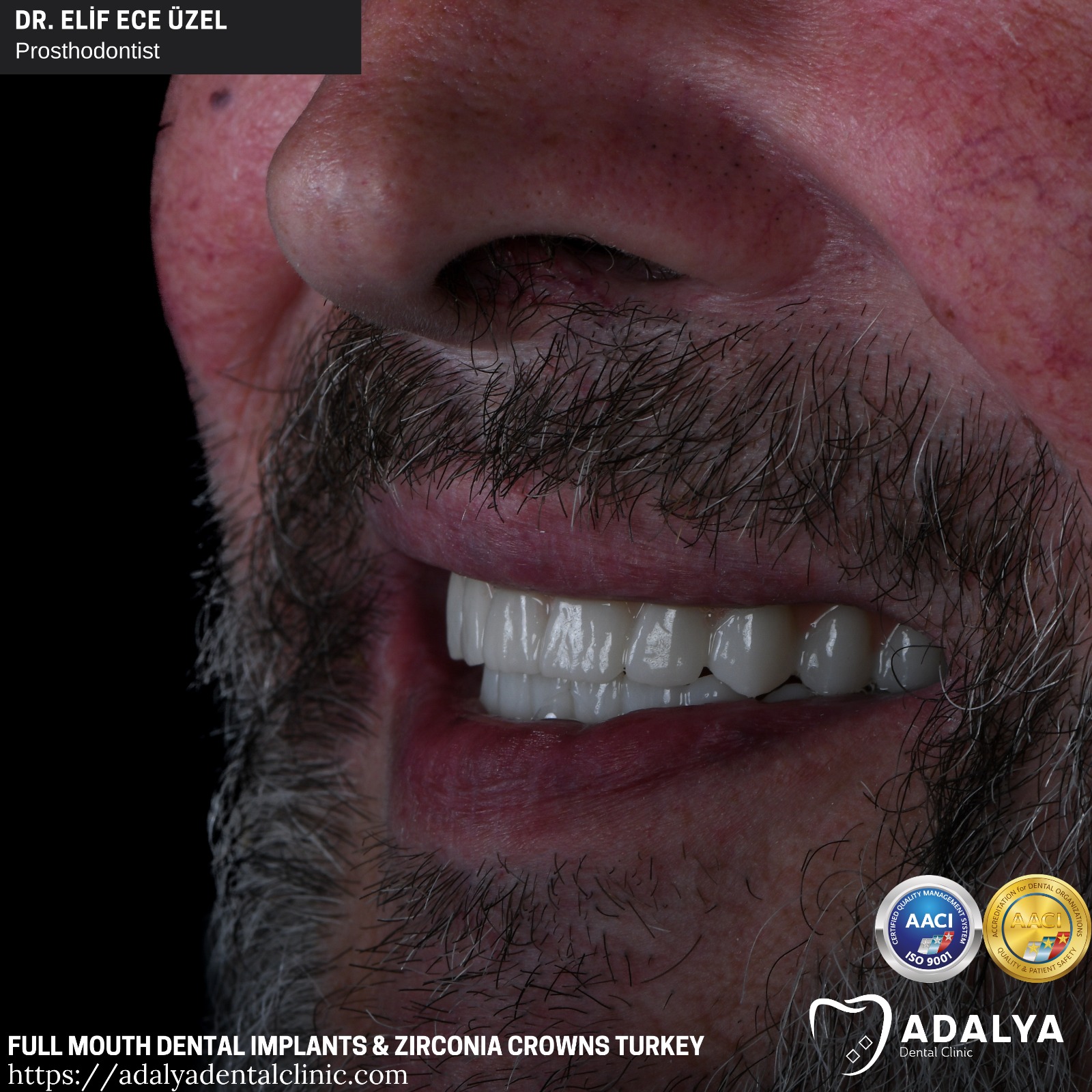 all on 6 full mouth dental implants turkey price package reviews antalya vip clinic cost