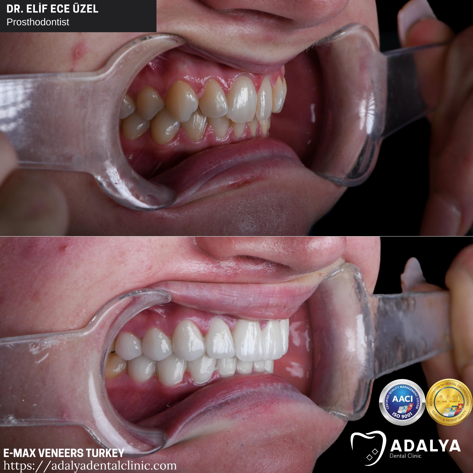 Emax-Kronen Türkei Kosten Antalya Istanbul Veneers Preispaket Dental