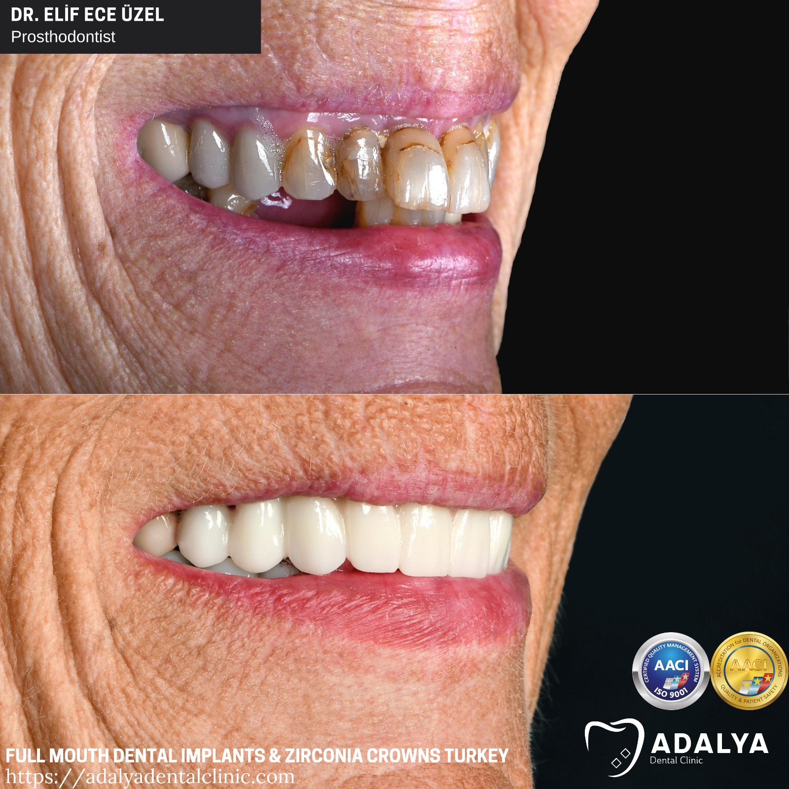turkey dentist antalya full mouth dental implants package deals cost price tooth