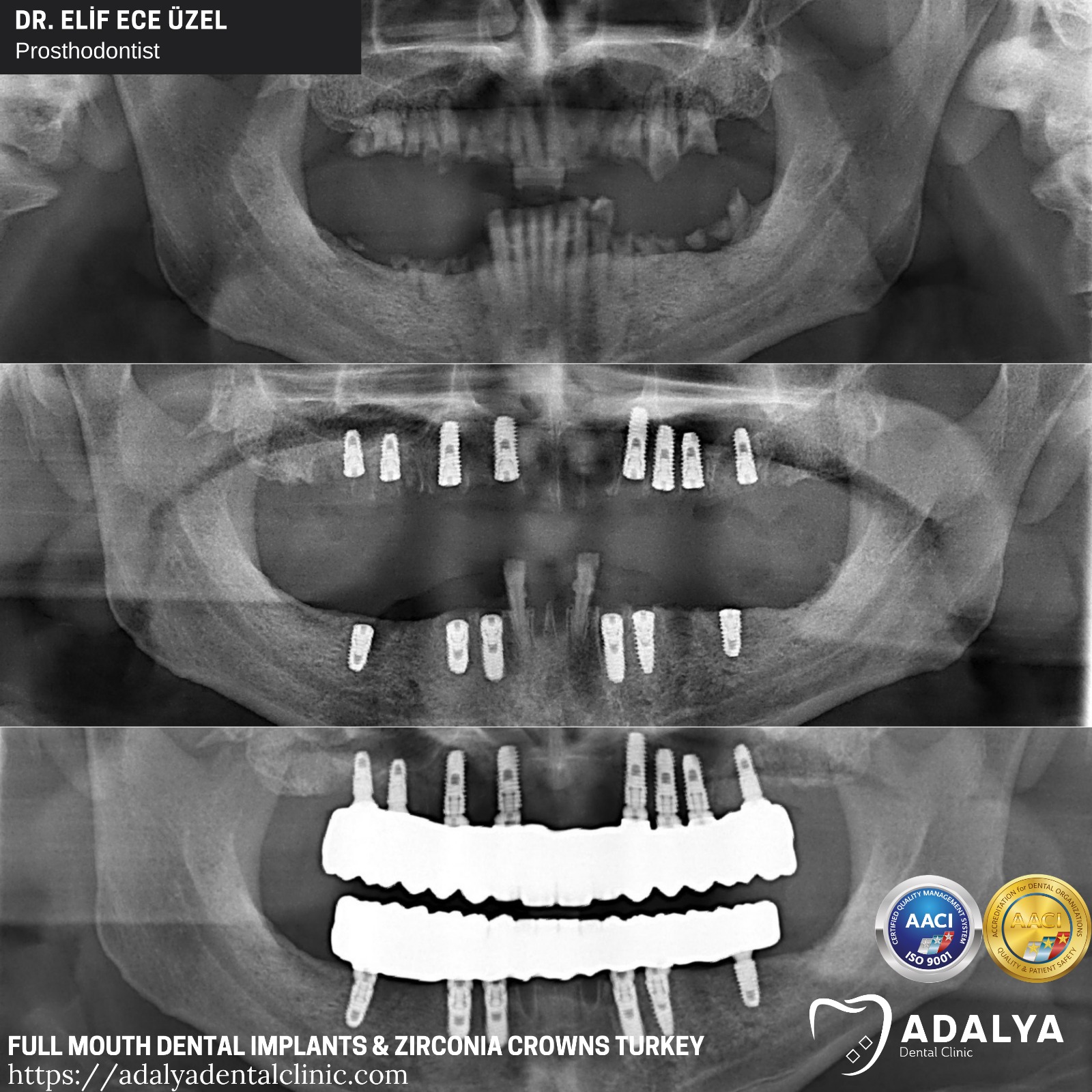 full mouth dental implants turkey price package deals cost