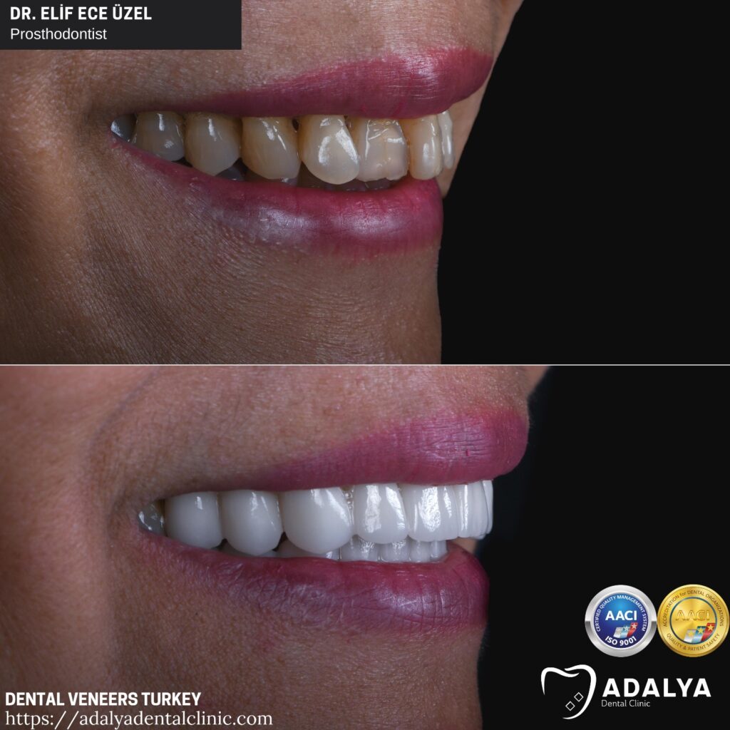 Dental Veneers Turkey Cost 2024, Porcelain, Antalya, Packages