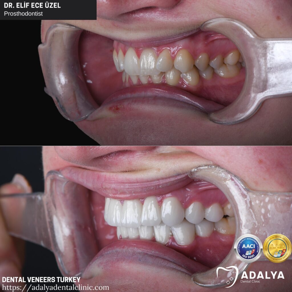 Dental Veneers Turkey Cost 2024, Porcelain, Antalya, Packages
