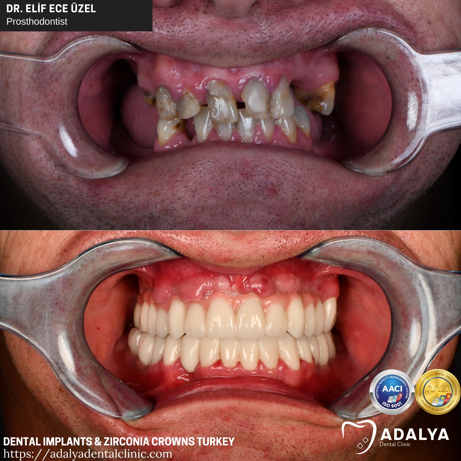 turkey teeth dental implants before after antalya cost price