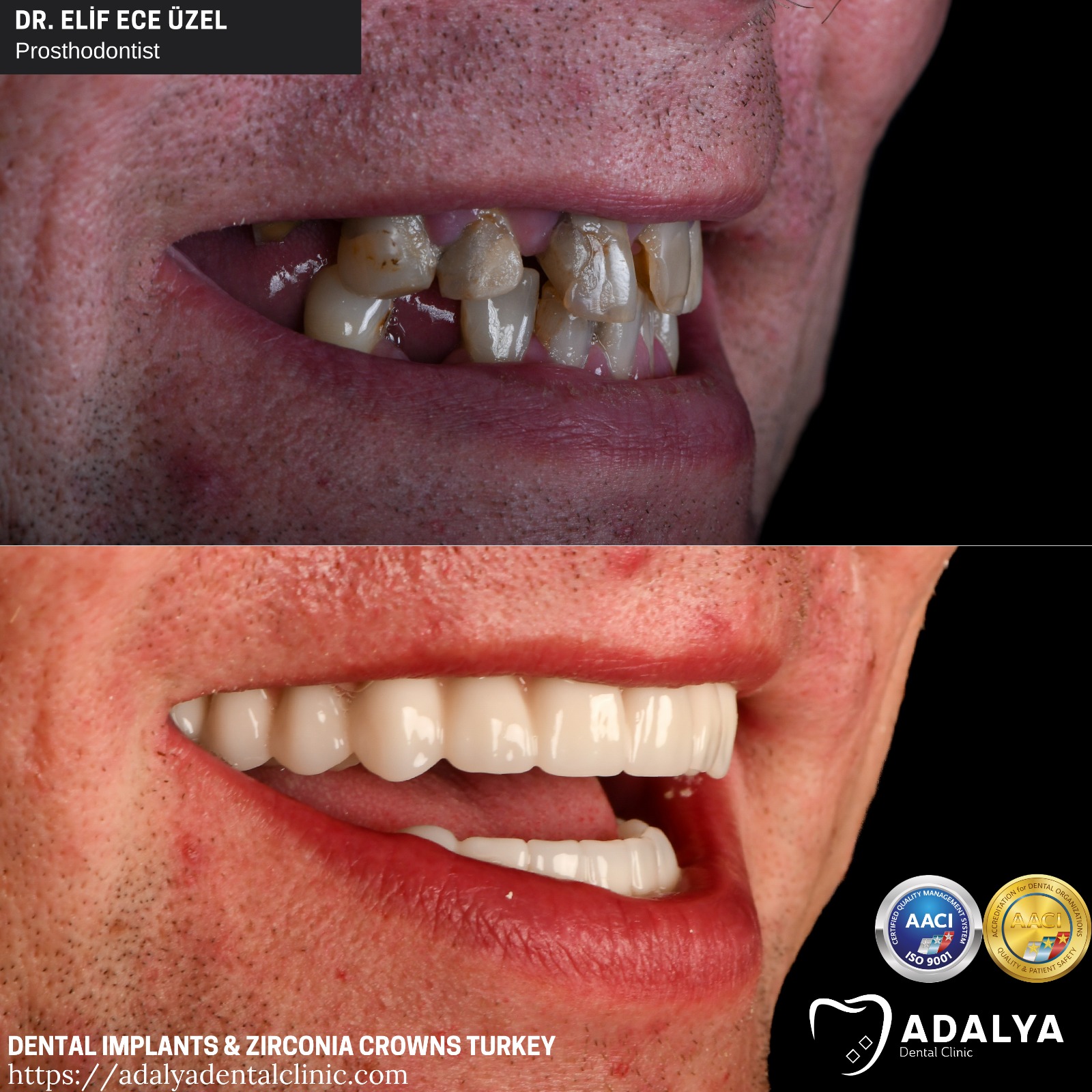 turkey teeth dental implants before after antalya price cost