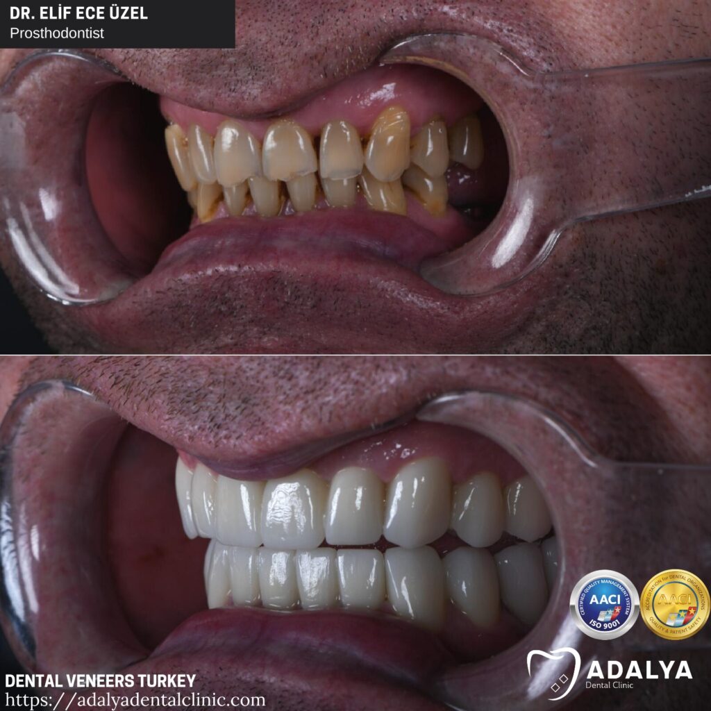 Dental Veneers Turkey Cost 2024, Porcelain, Antalya, Packages