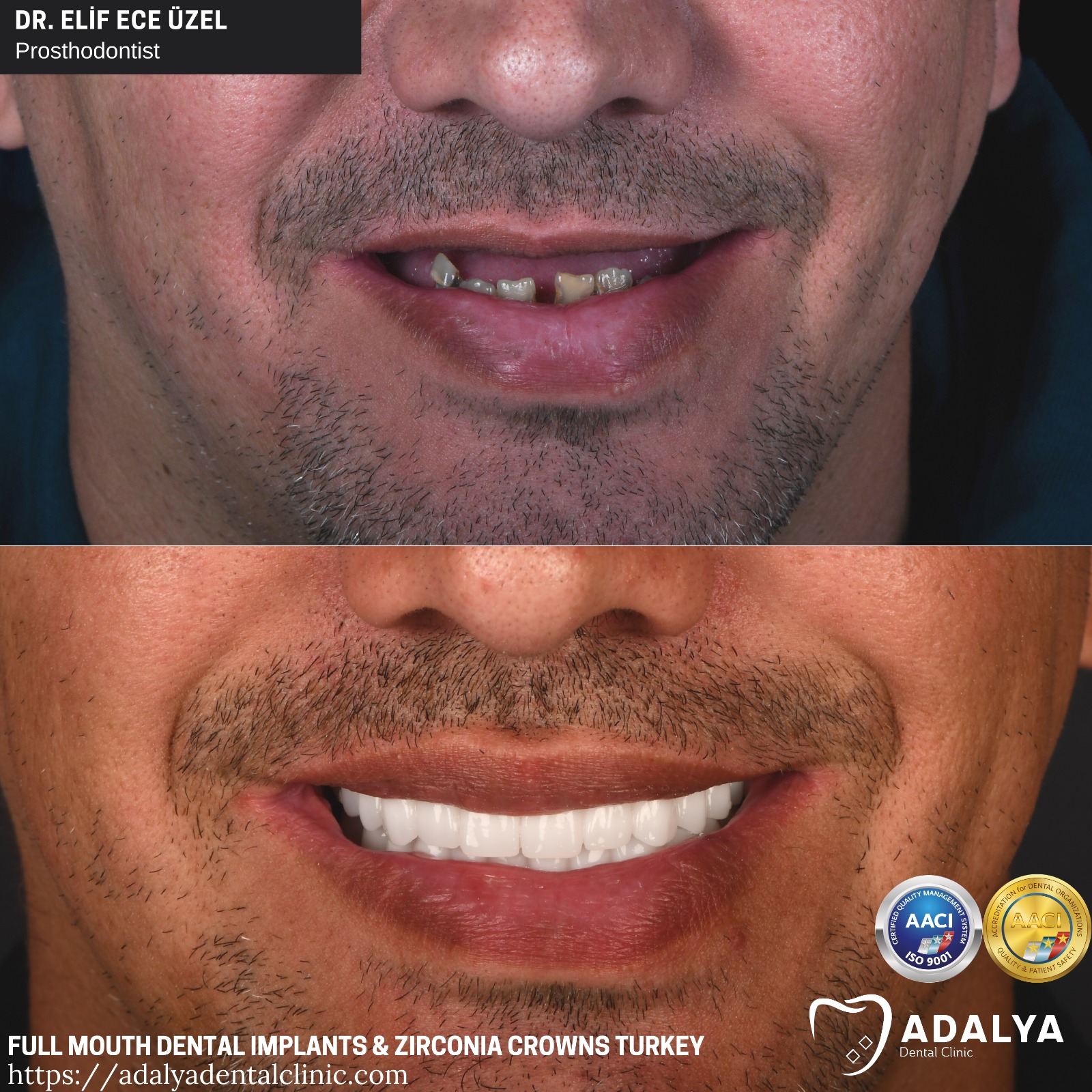 turkey teeth before after full mouth dental implants antalya